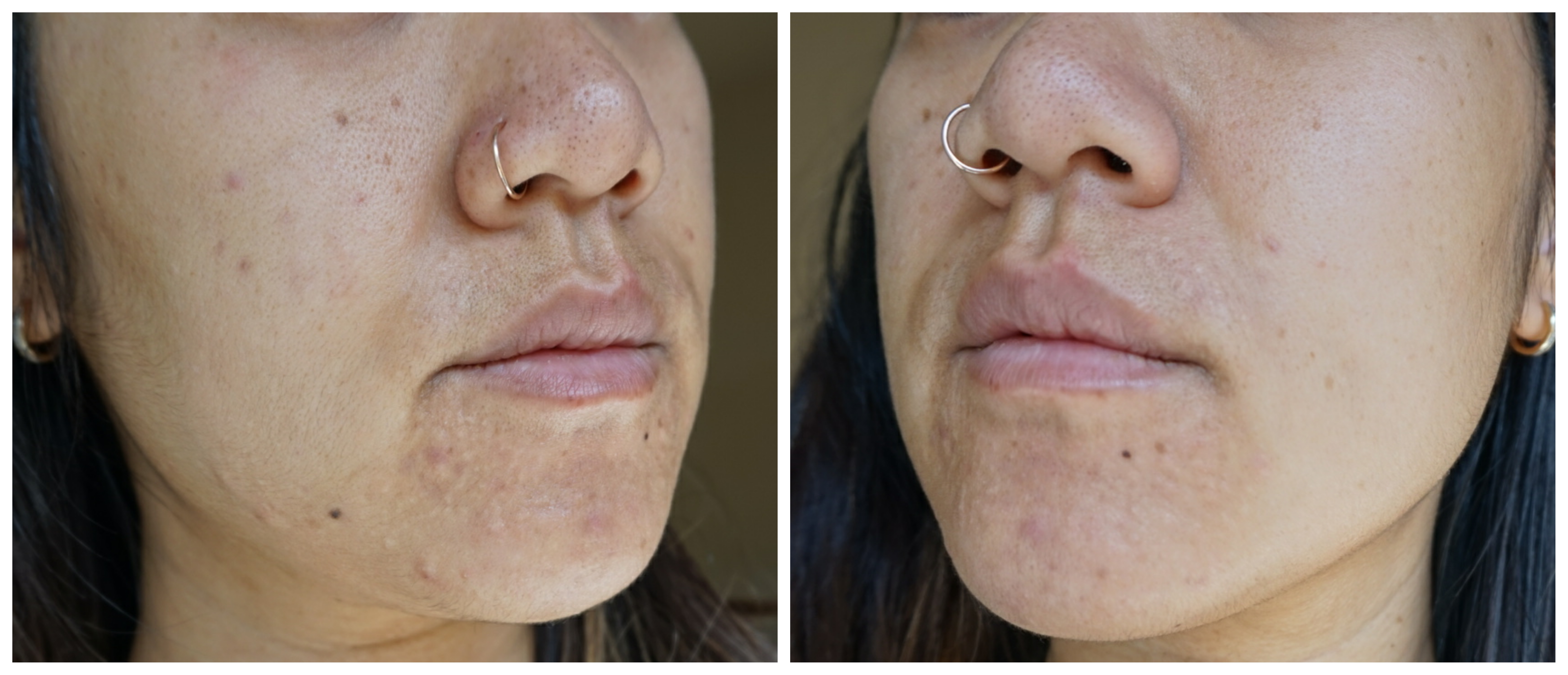 [Routine Help] Bumpy acne scars, pih, uneven skin tone, visible pores