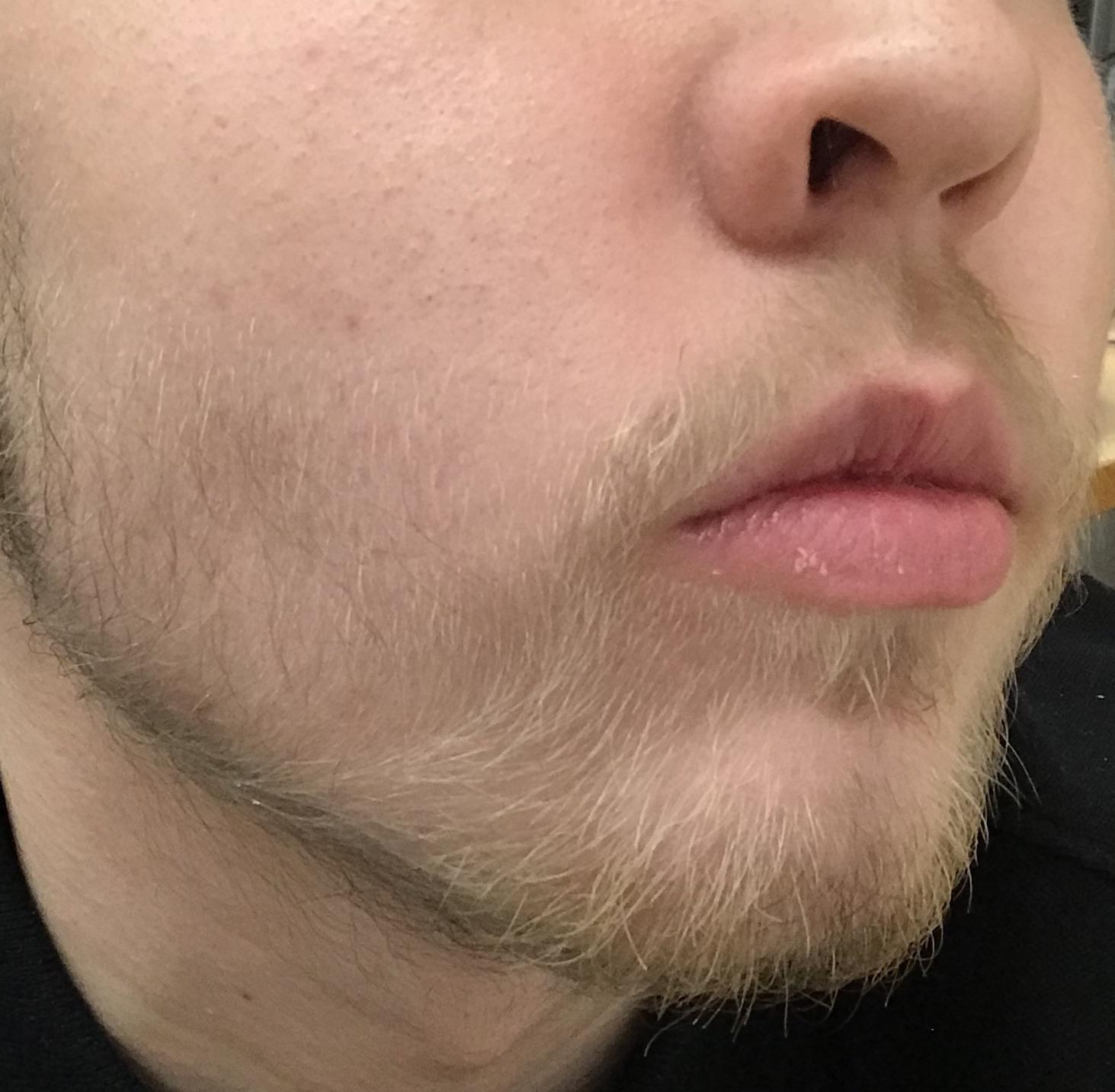 What are these hairs, and if they are vellus since they are so blonde. Why on earth are they so