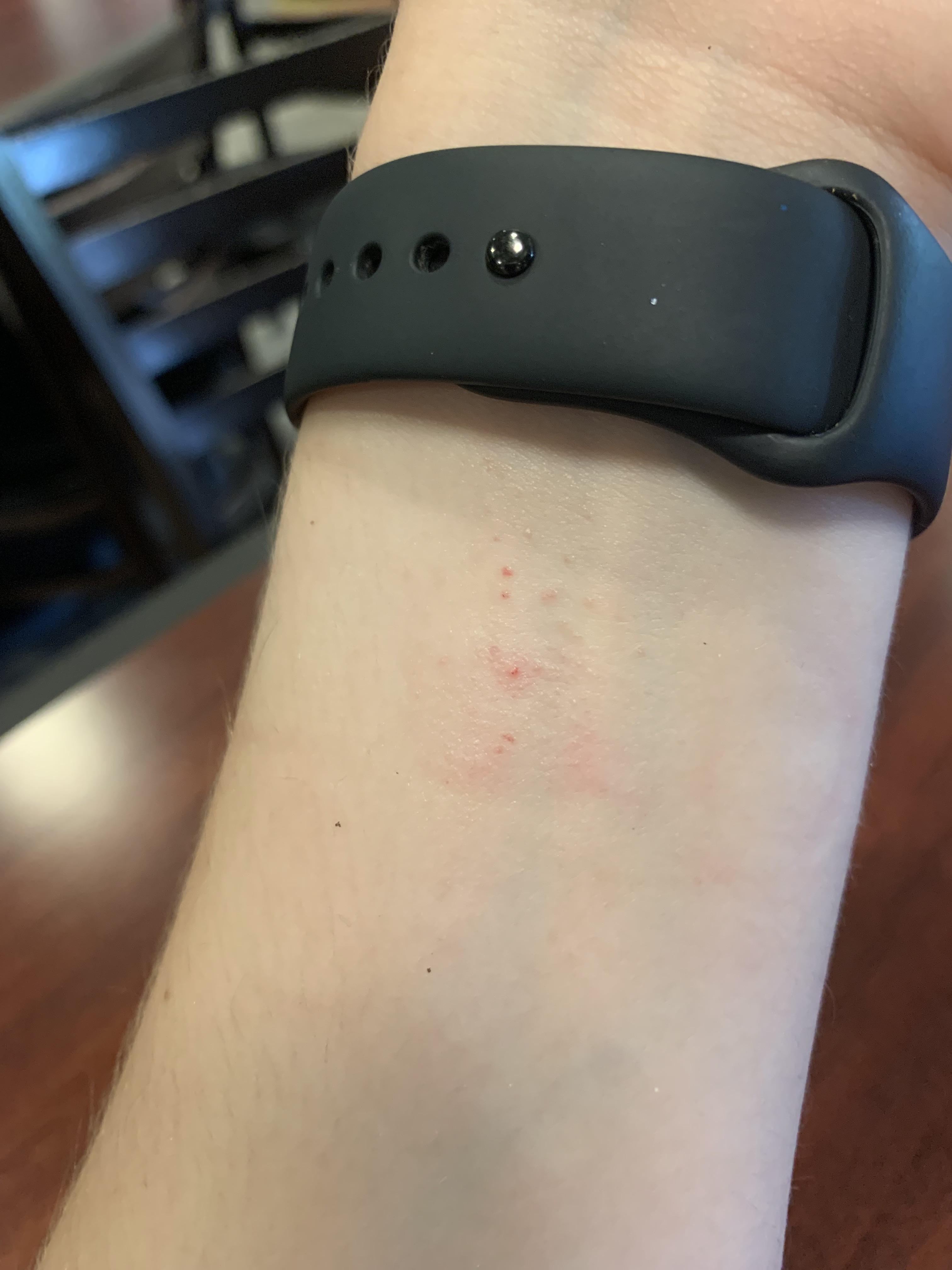 My watch band gave me a rash r/mildlyinfuriating