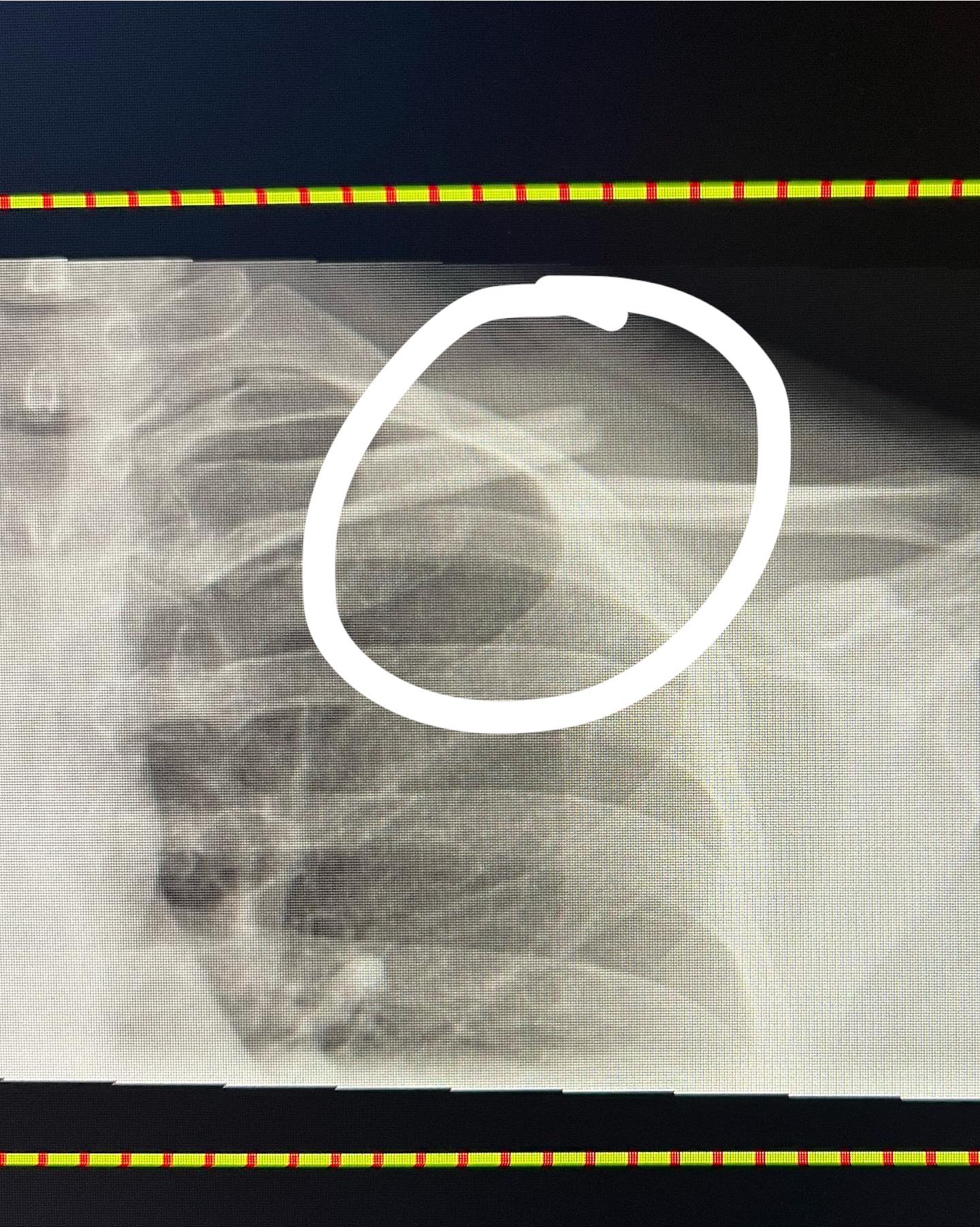 Does this collarbone fracture look like it will need surgery?? r/medical