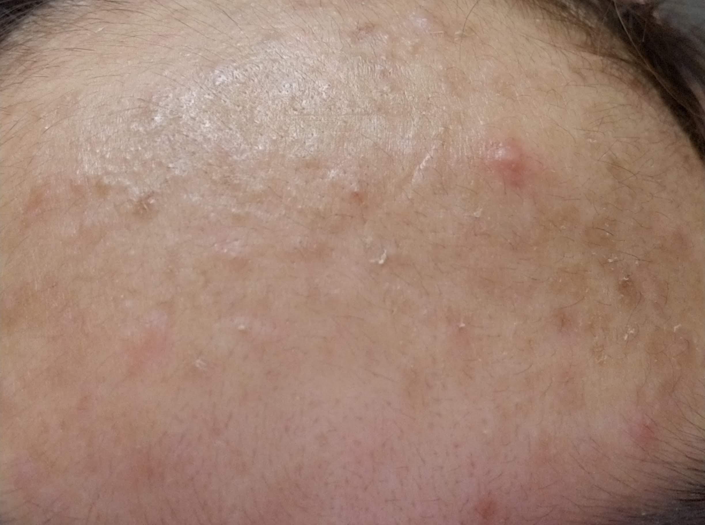 [acne] help with sebum plugs/filaments on forehead and nose r