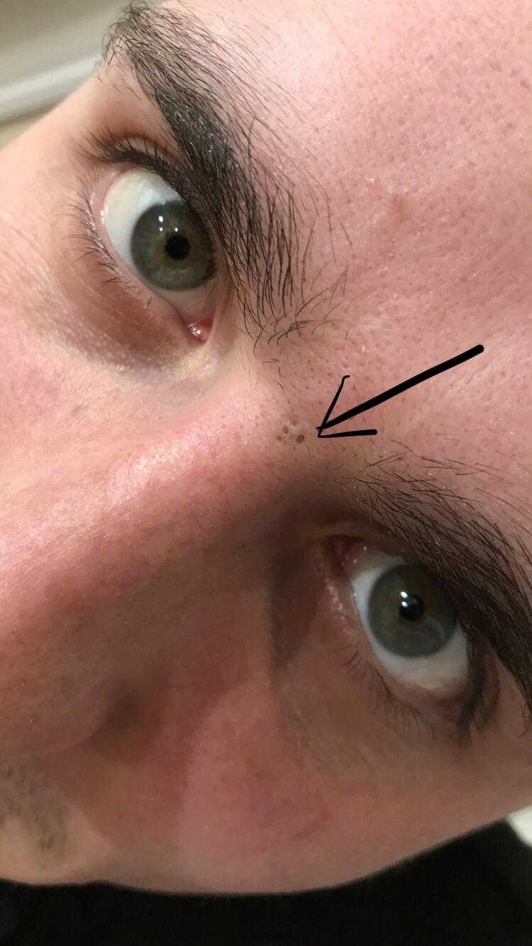 [Skin Concerns] Boyfriend has a huge plug in between his eyes and I’m