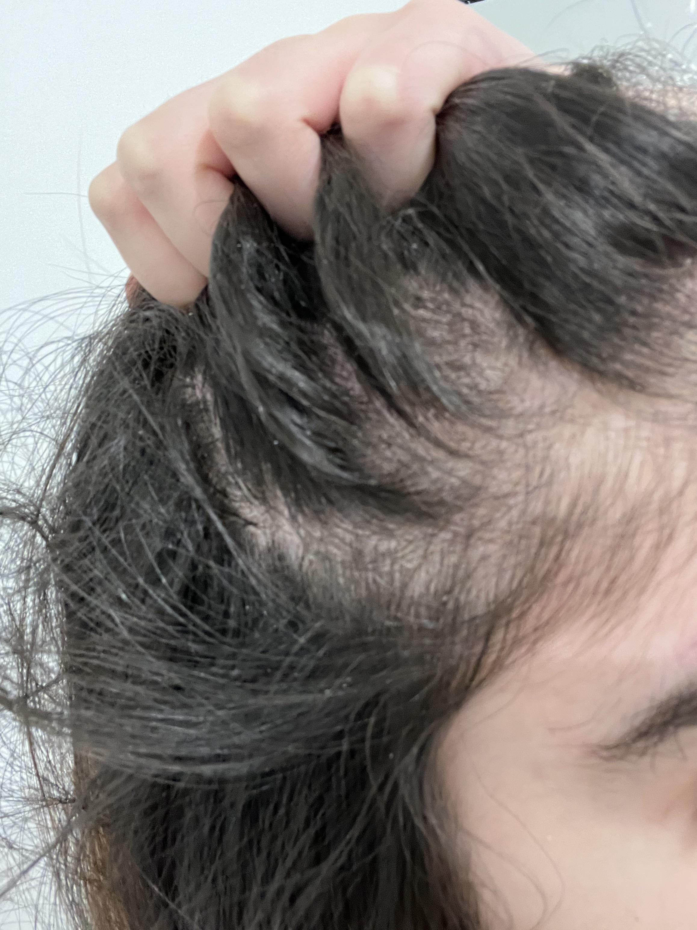 Hair loss r/Dermatology