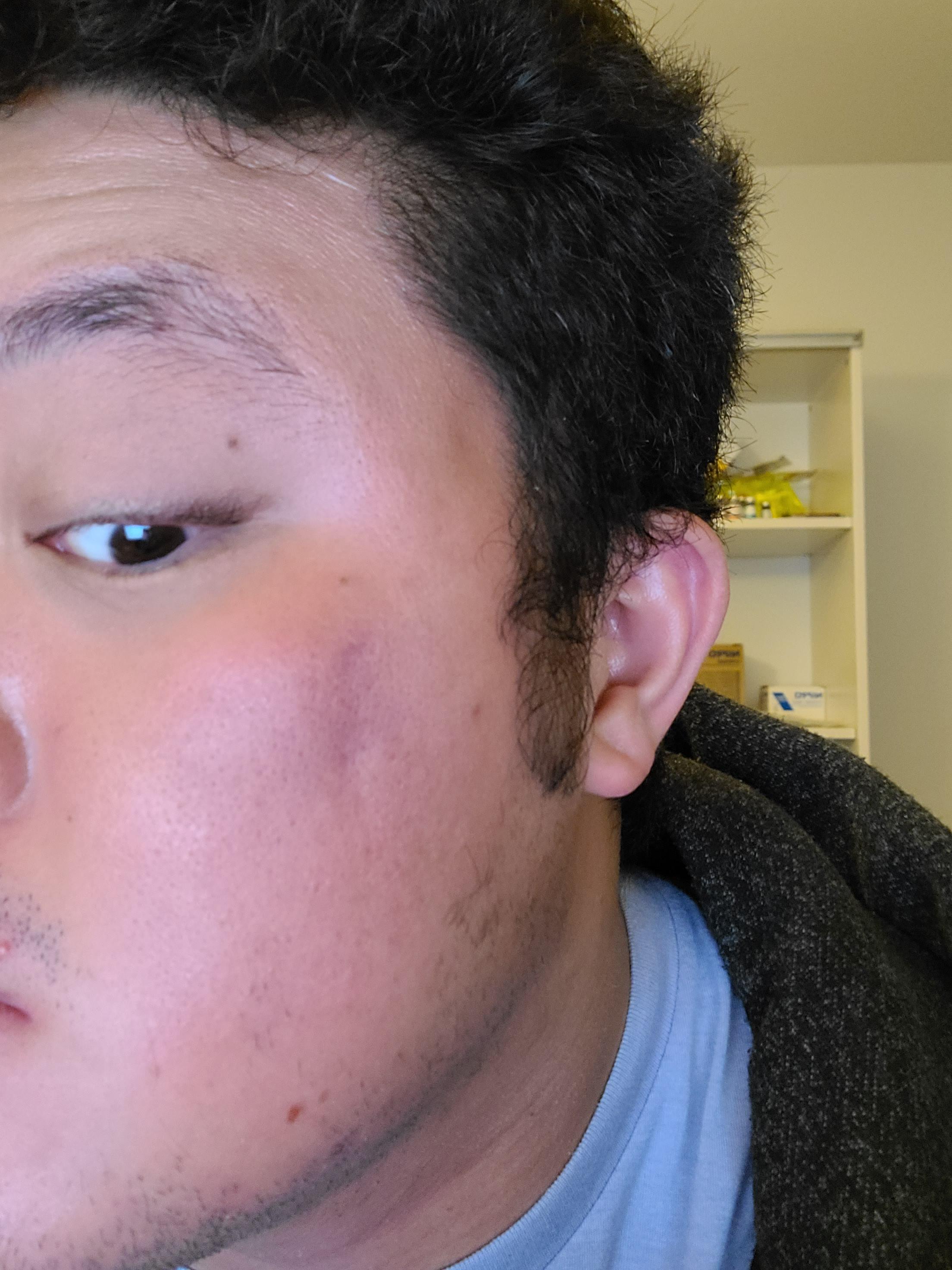 [Skin Concern] A big acne popped in a weird way where there was lot of