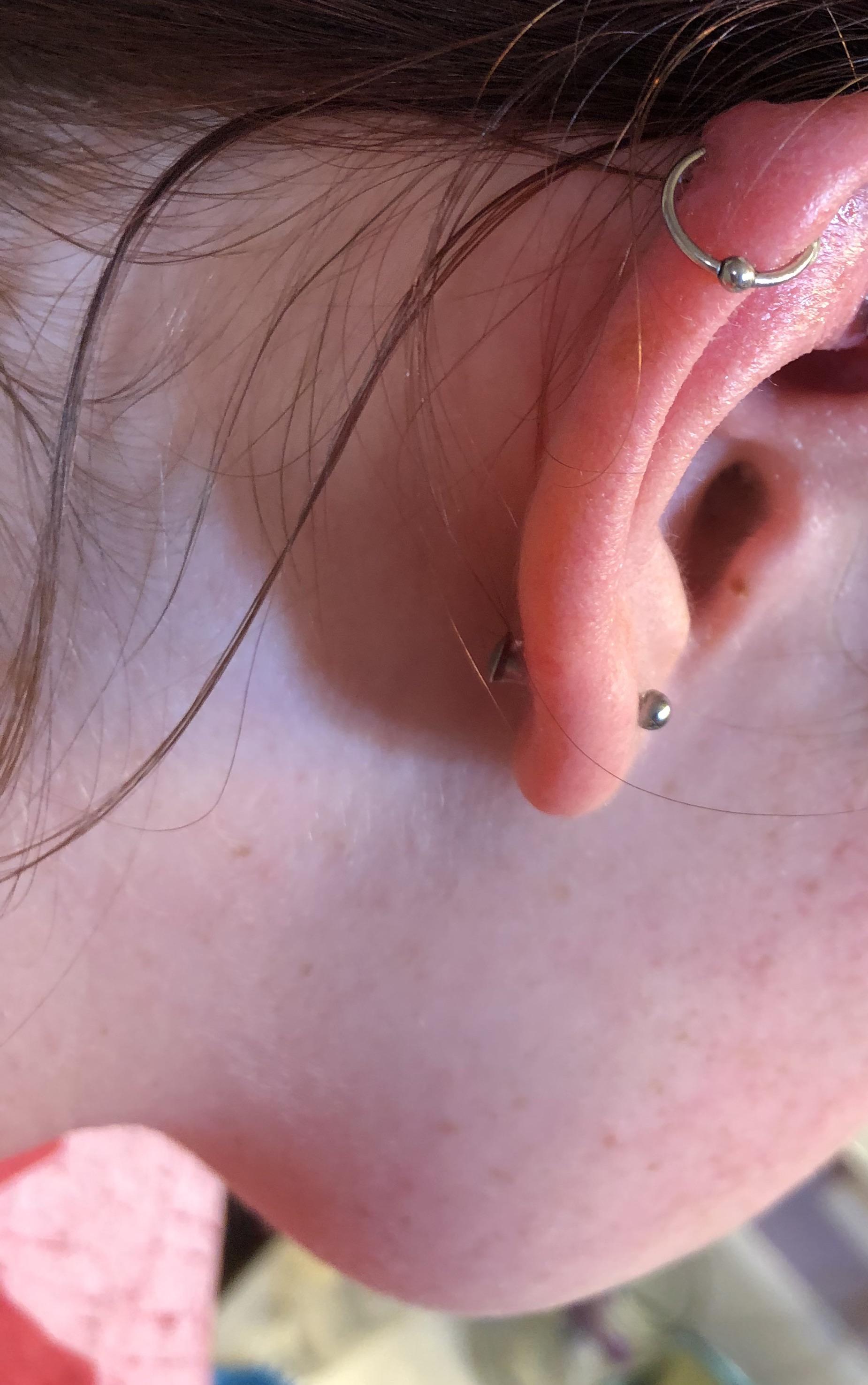 What is this bump on my Helix that isn’t a keloid? I’ve had this