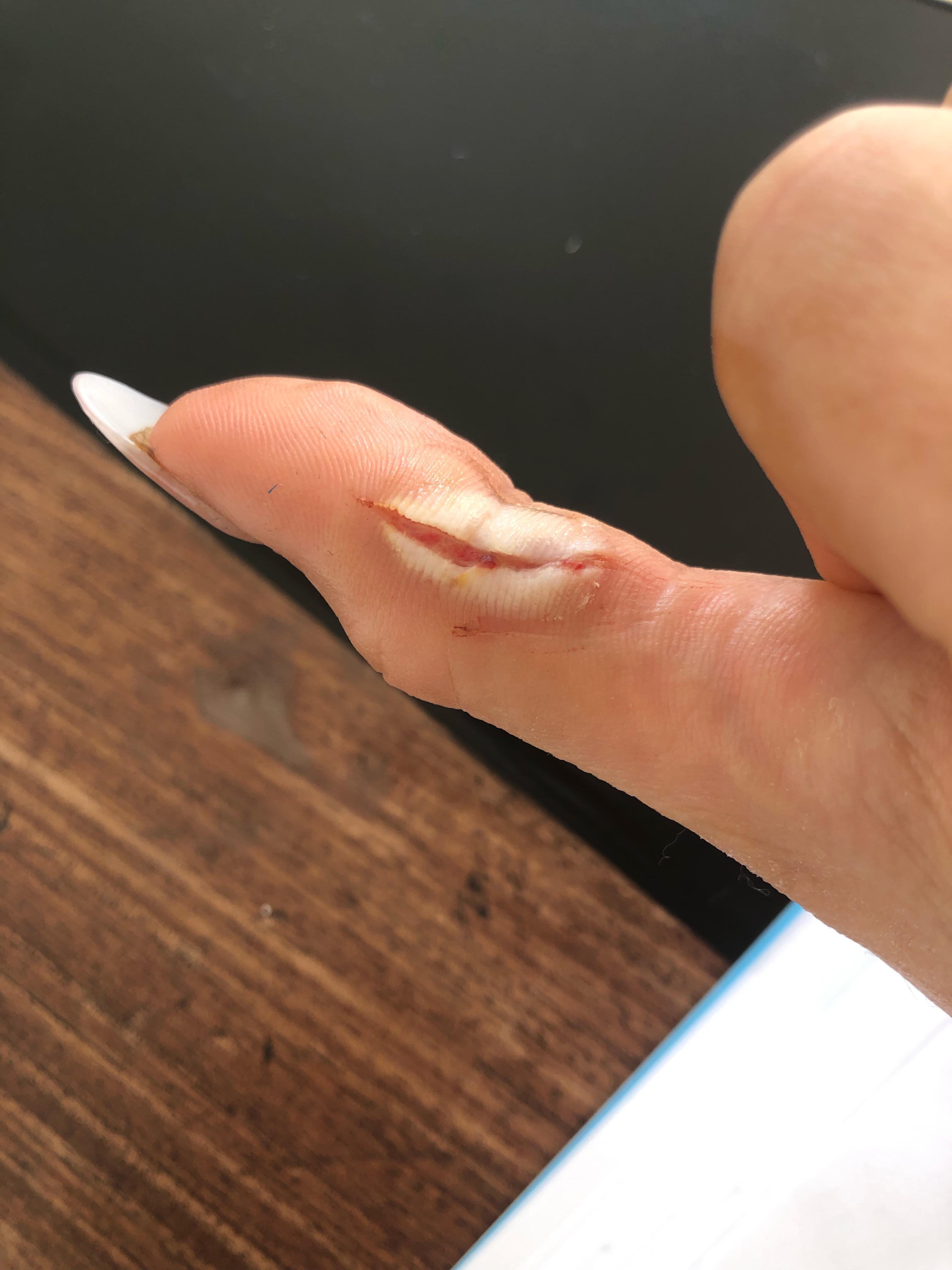 I cut my hand like a week ago, is the white skin problematic??? r