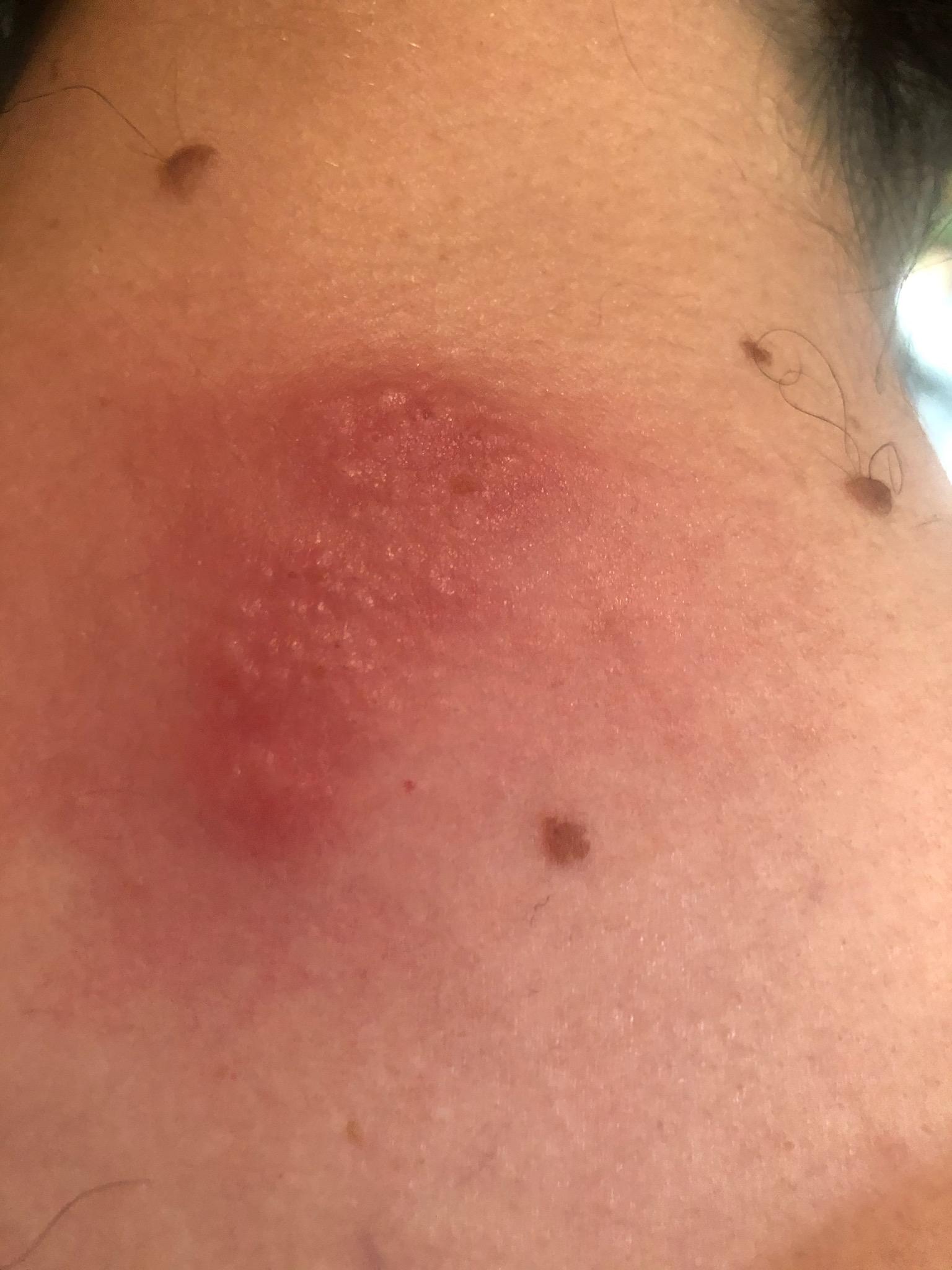Rash on the back of my neck popped up three days ago. I
