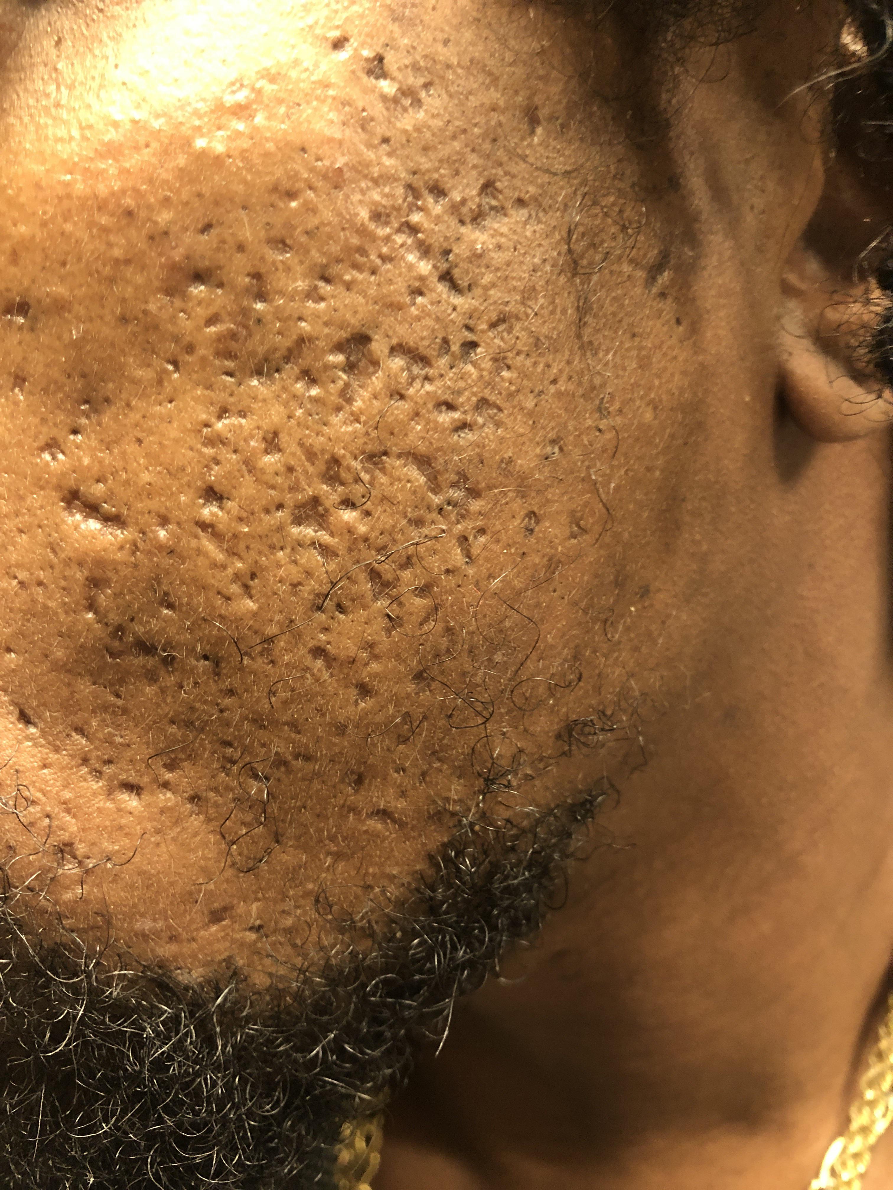 [Skin Concern] HELP!!! I get a lot of big blackheads and I have a lot
