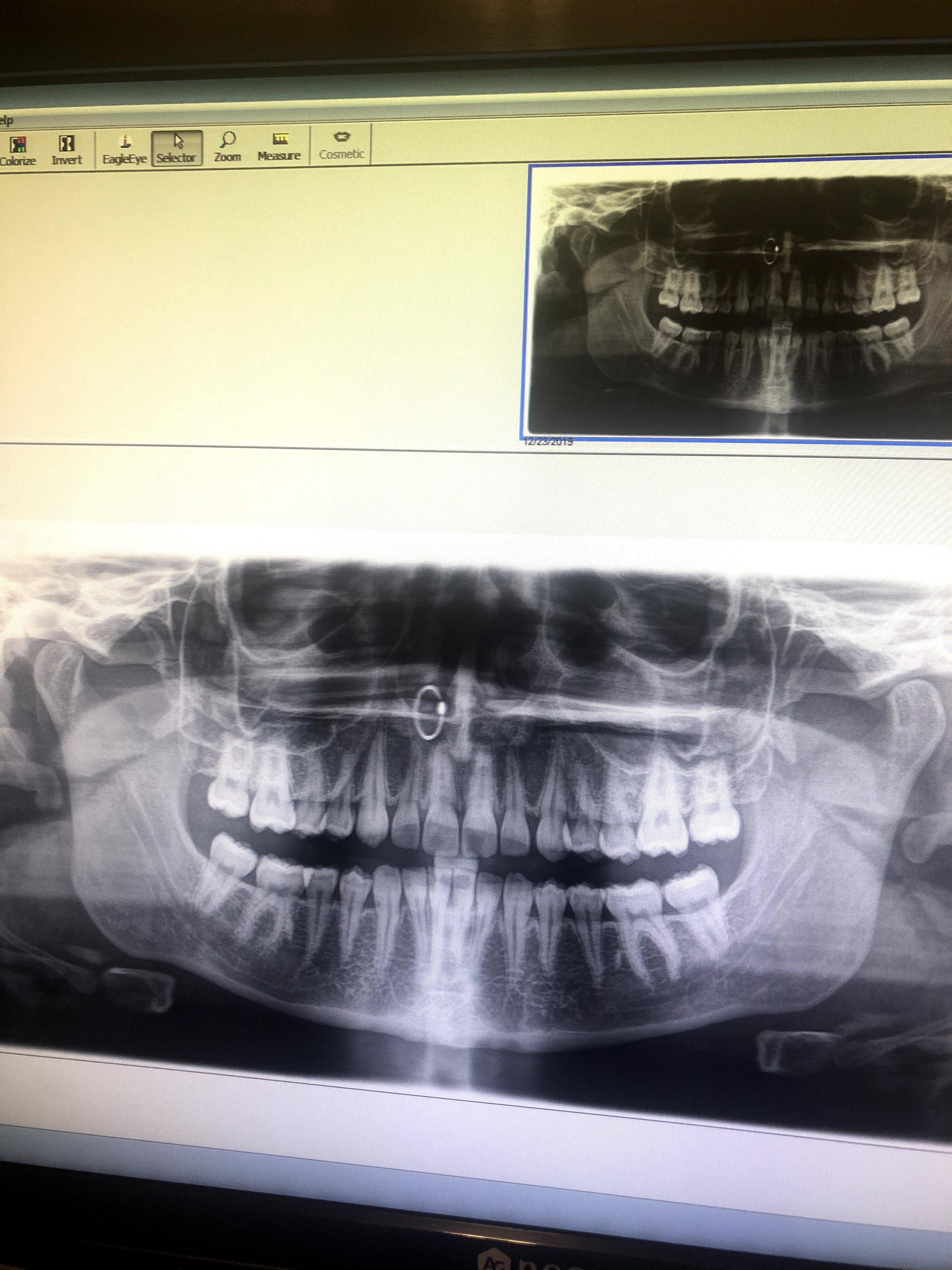 Was told I could keep my nose ring on during xrays... Got a laugh out