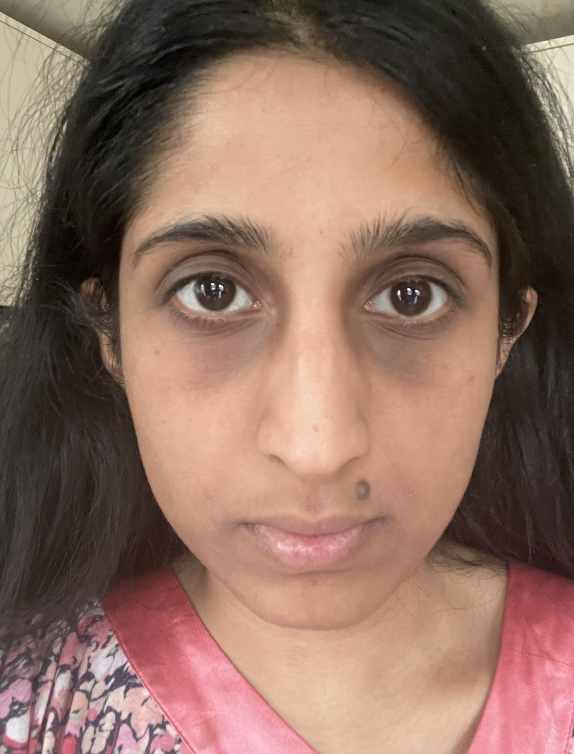 Details 129+ tea bags on eyes reddit best xkldase.edu.vn