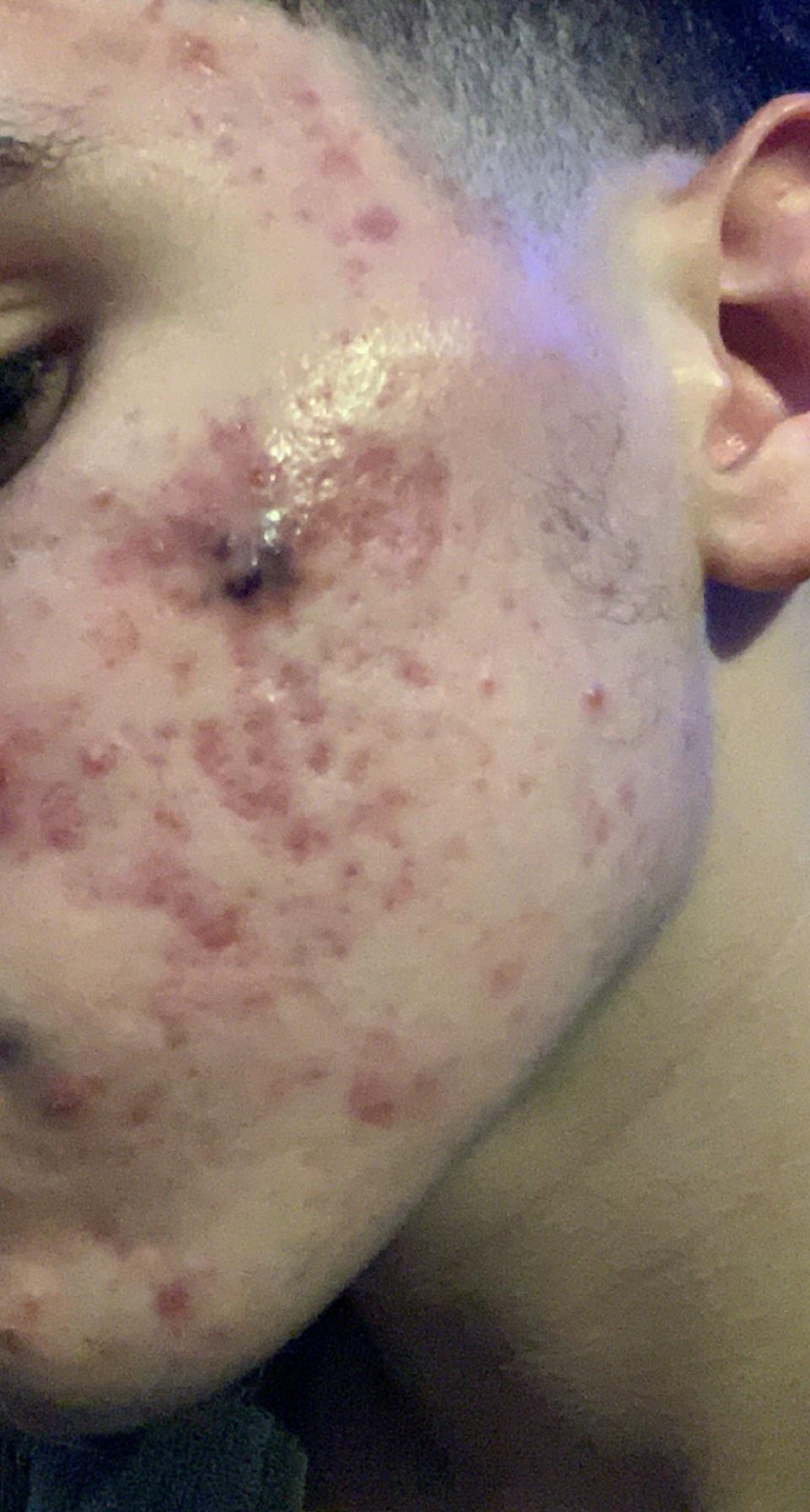 i need help acne