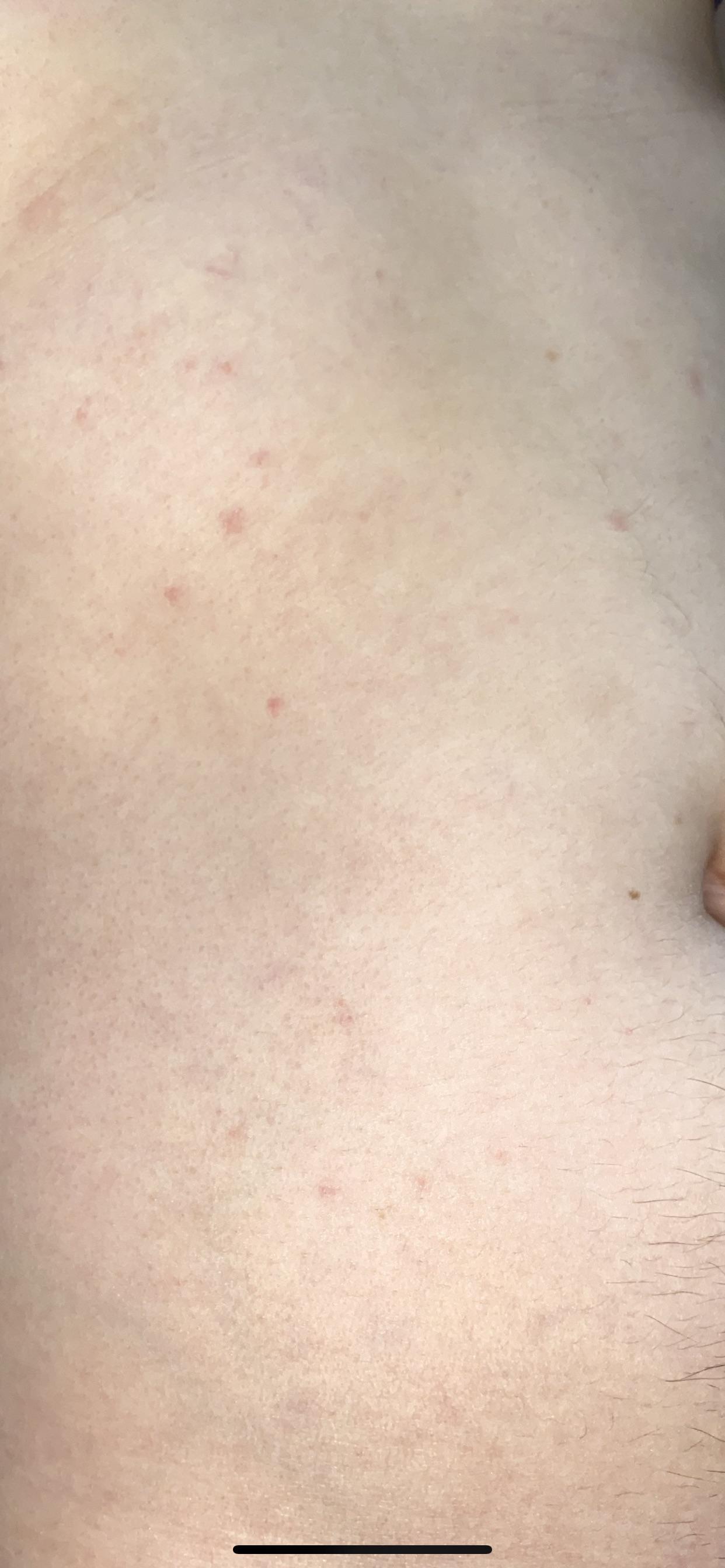 Whats these red spots on my stomach? Painless, no itch, soft, very