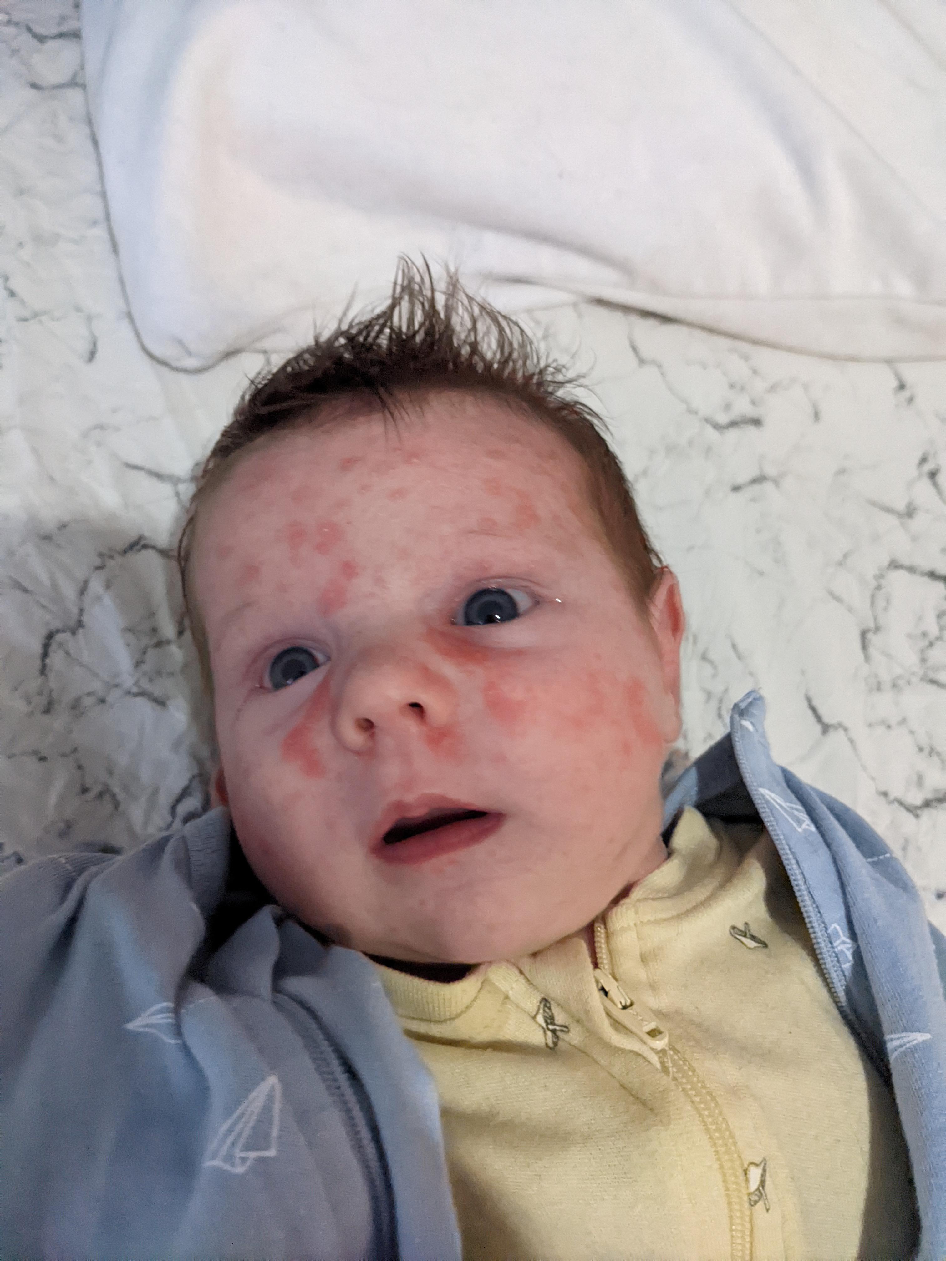 Does this look like baby acne or more like a lactose intolerance or