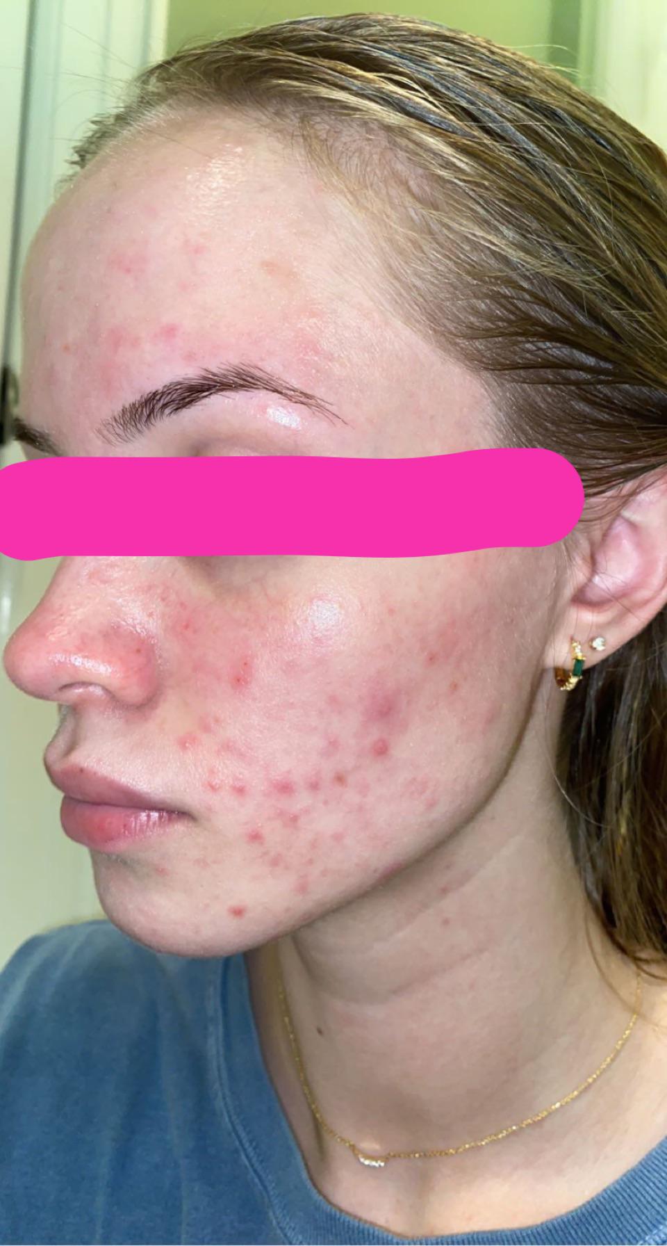 Dry and brittle hair from acutane? Accutane