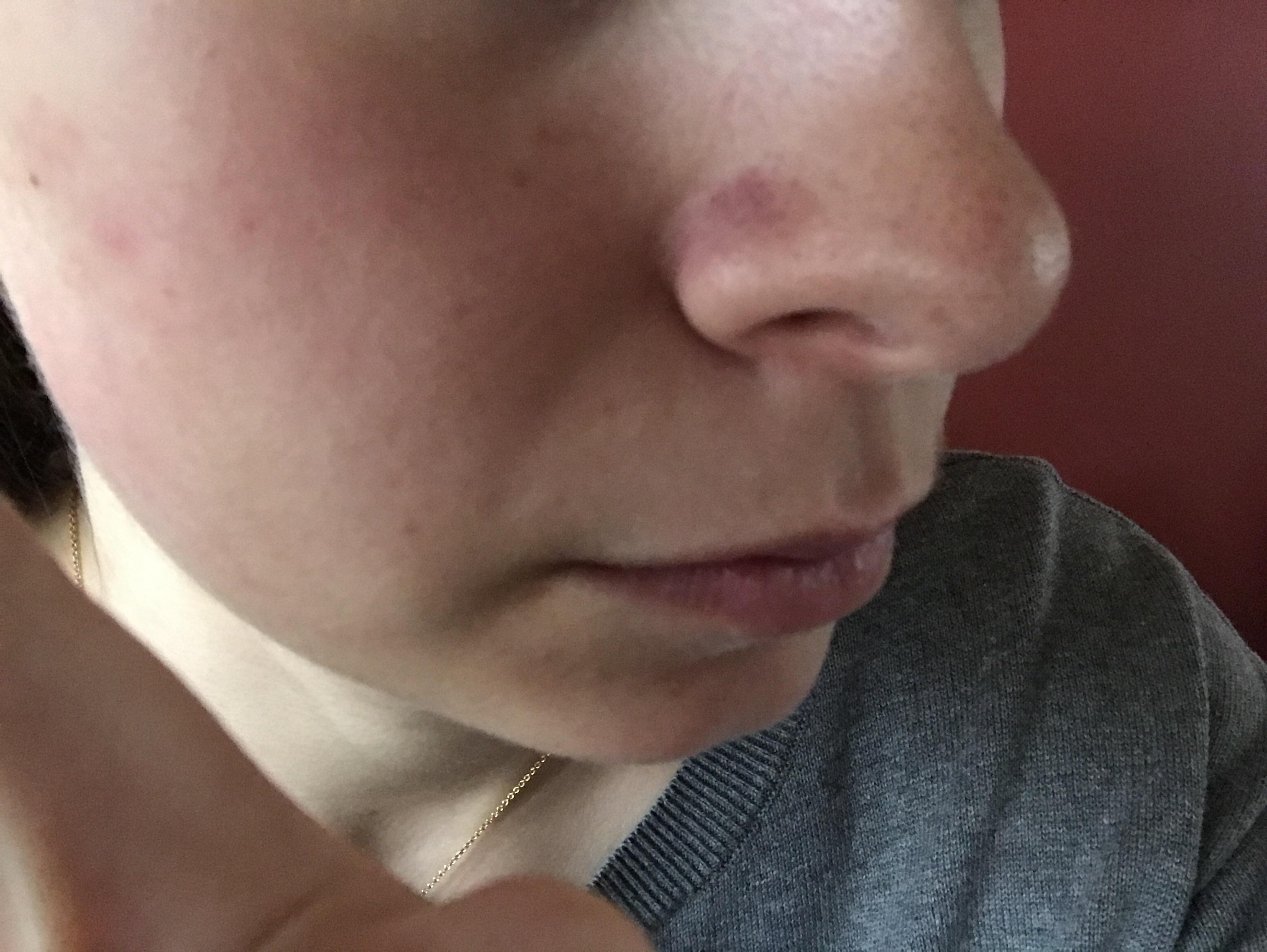[skin concern] I've had dark spots, & also huge pores, on either side of my nose for a long