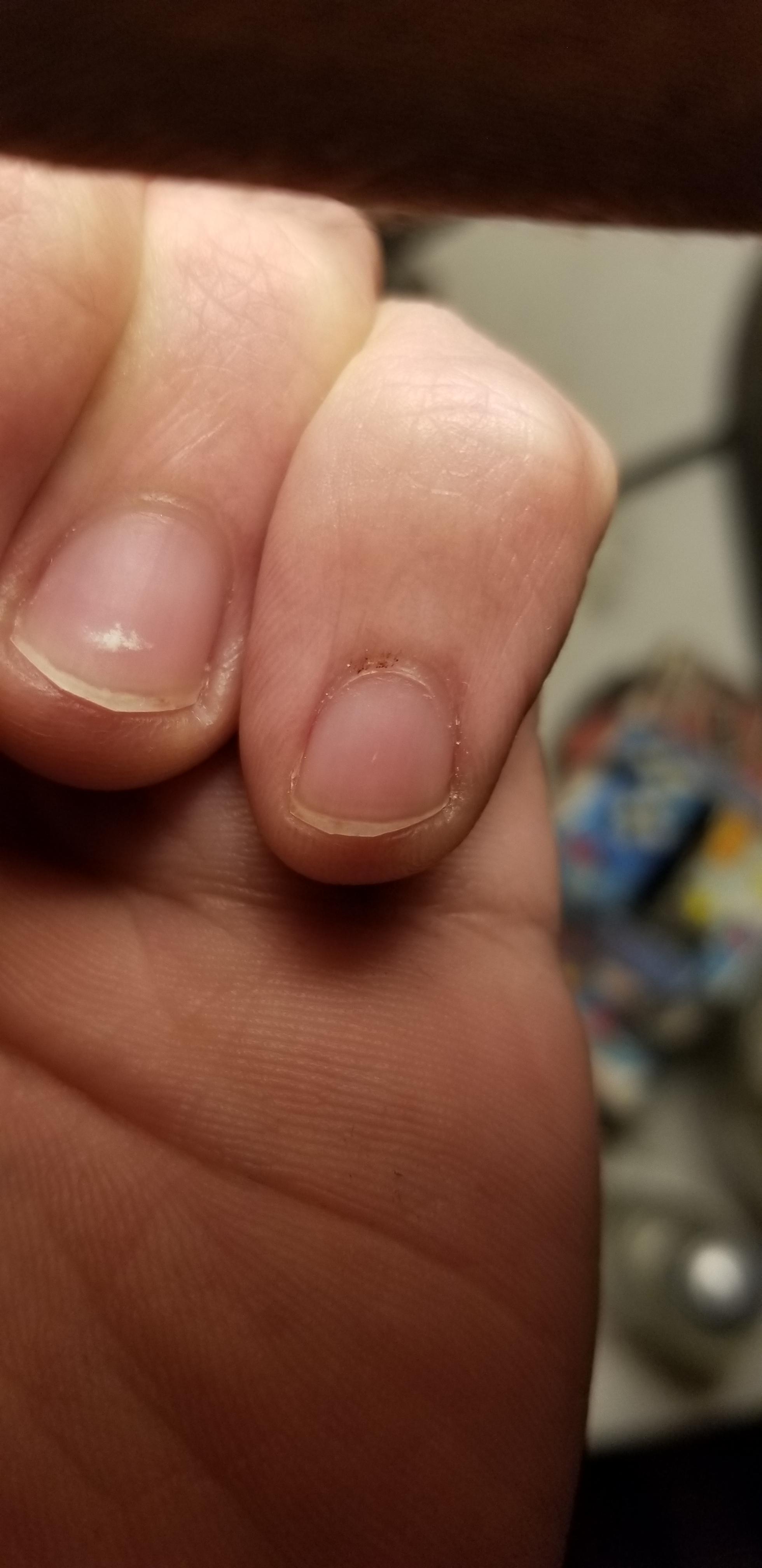 Have these spots on my cuticles, check comments of shared post for more