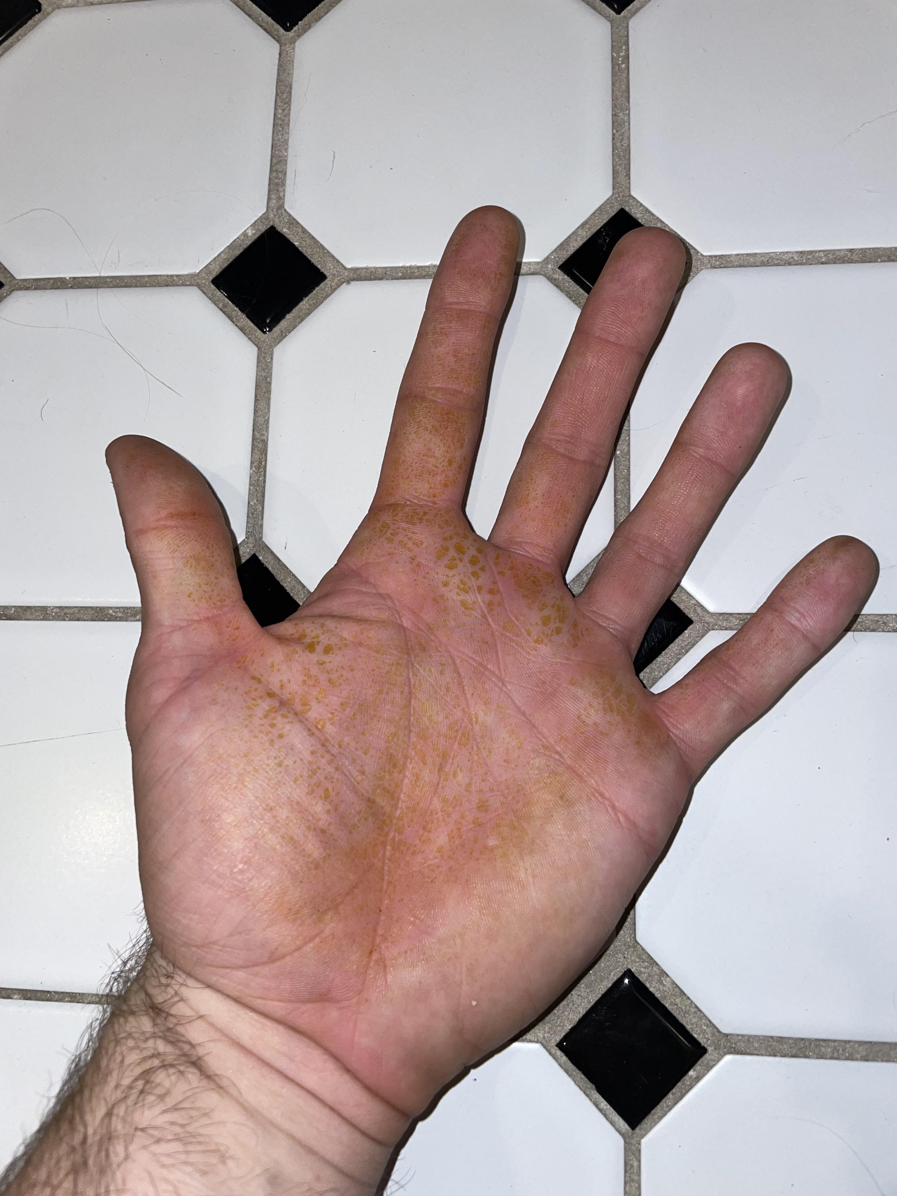 Mild allergic reaction to cutting butternut squash r/mildlyinteresting