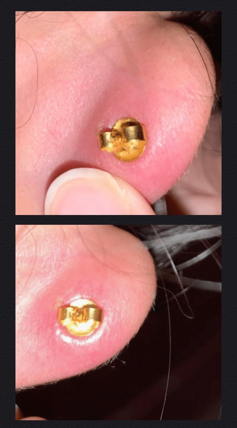 Swollen pulsing cartilage HELP. On the 4th day my piercing became