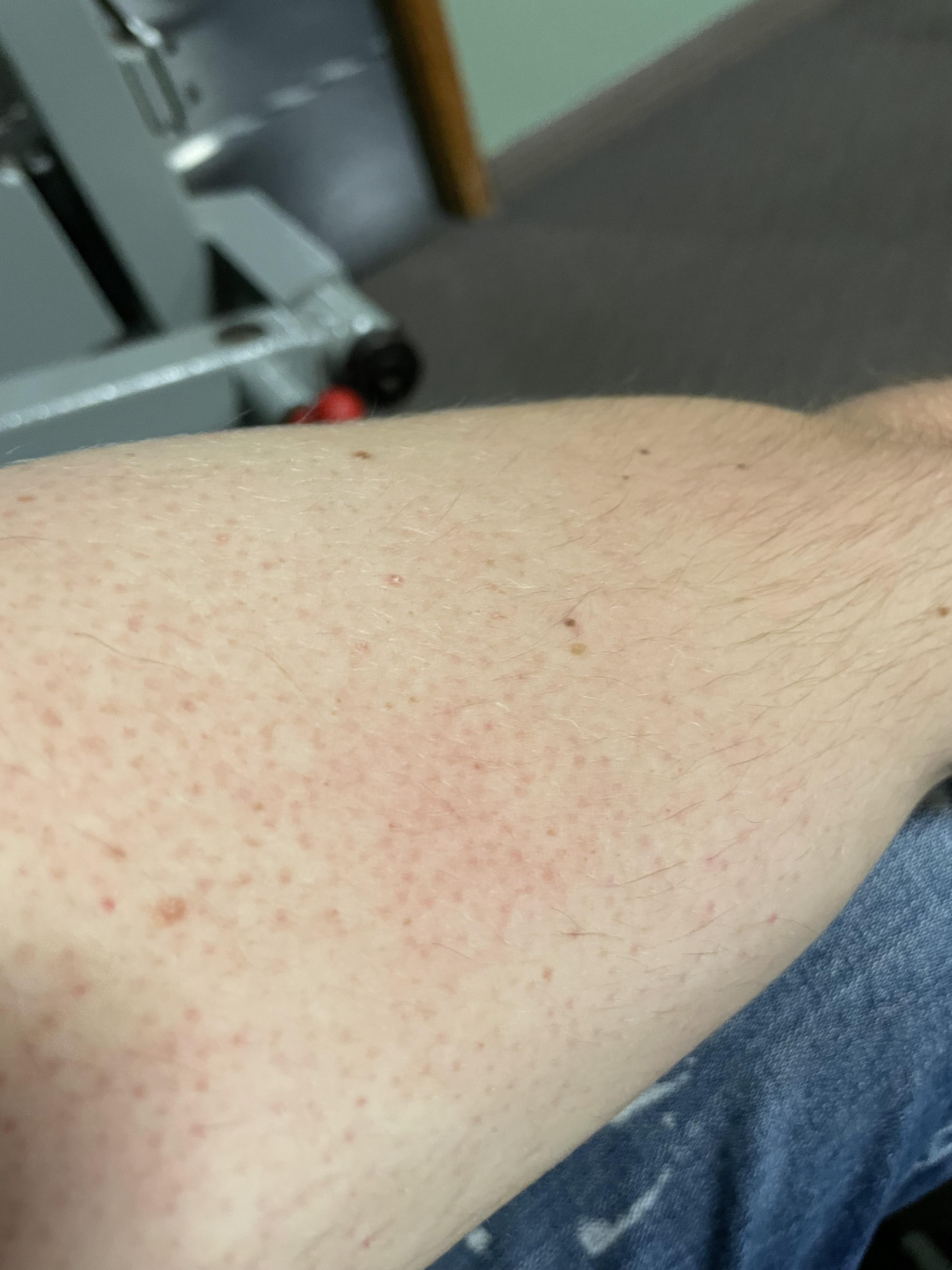 Have these bumps on my upper arms, (just beneath shoulders) no