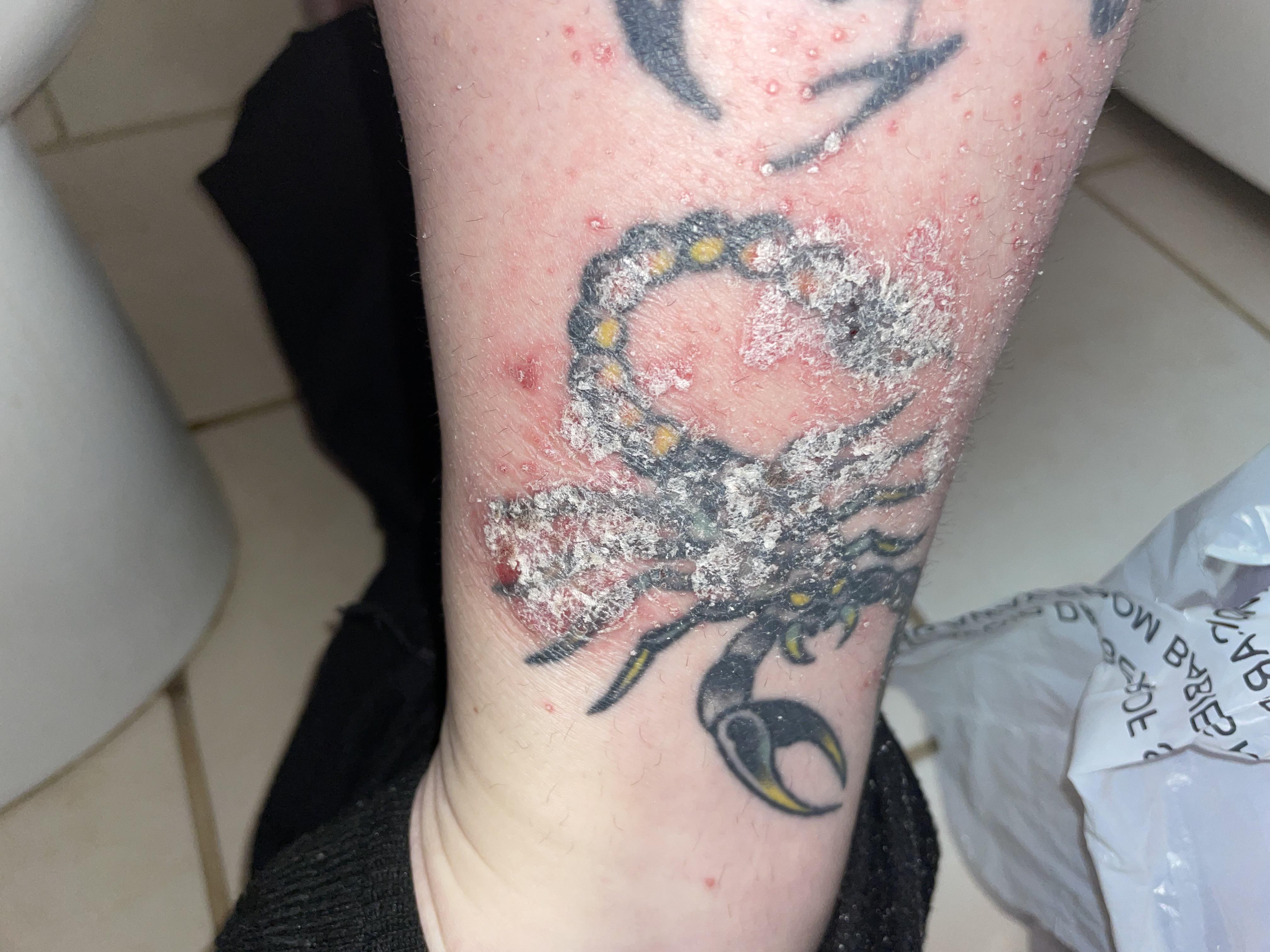 First full body flare up in my life. Waiting for my derm app bc they