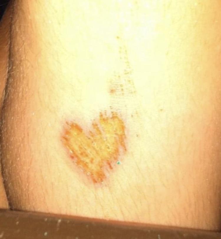 My daughter fell and scraped her leg and it’s shaped like a little