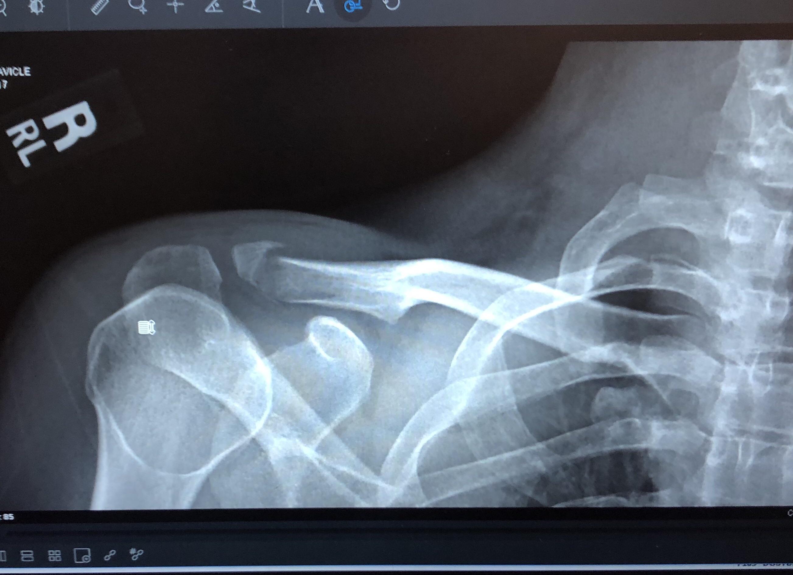 my collarbone r/mildlypenis
