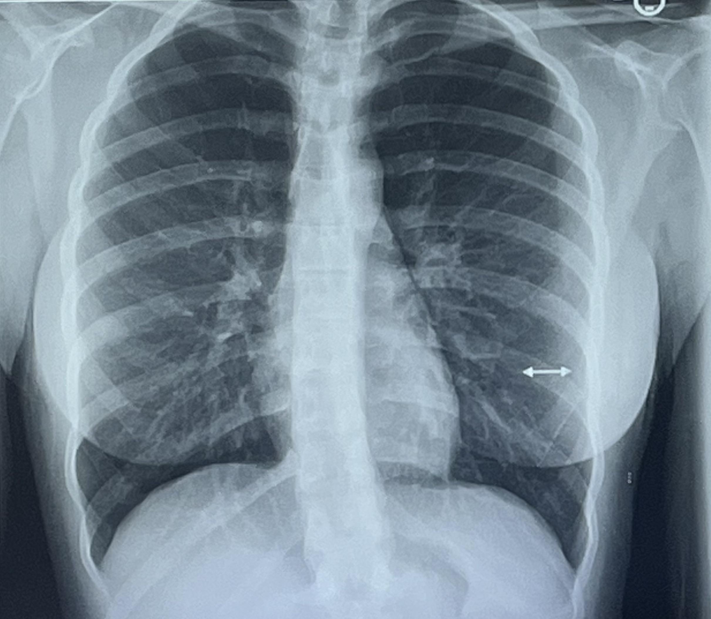 got my chest xray back today… r/piercing