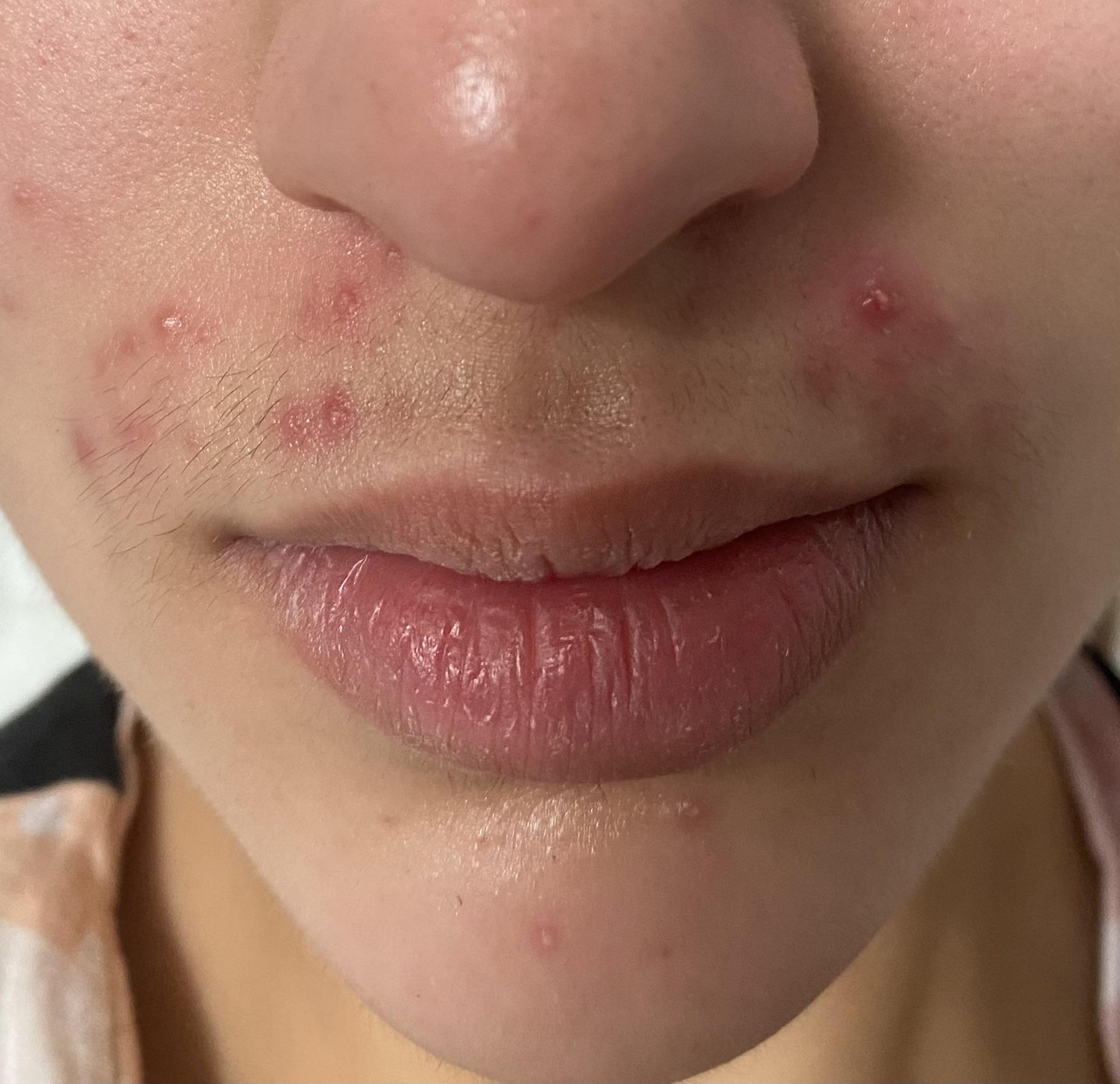 Keep getting breakouts on upper lip. Sometimes come up in twos. [Acne