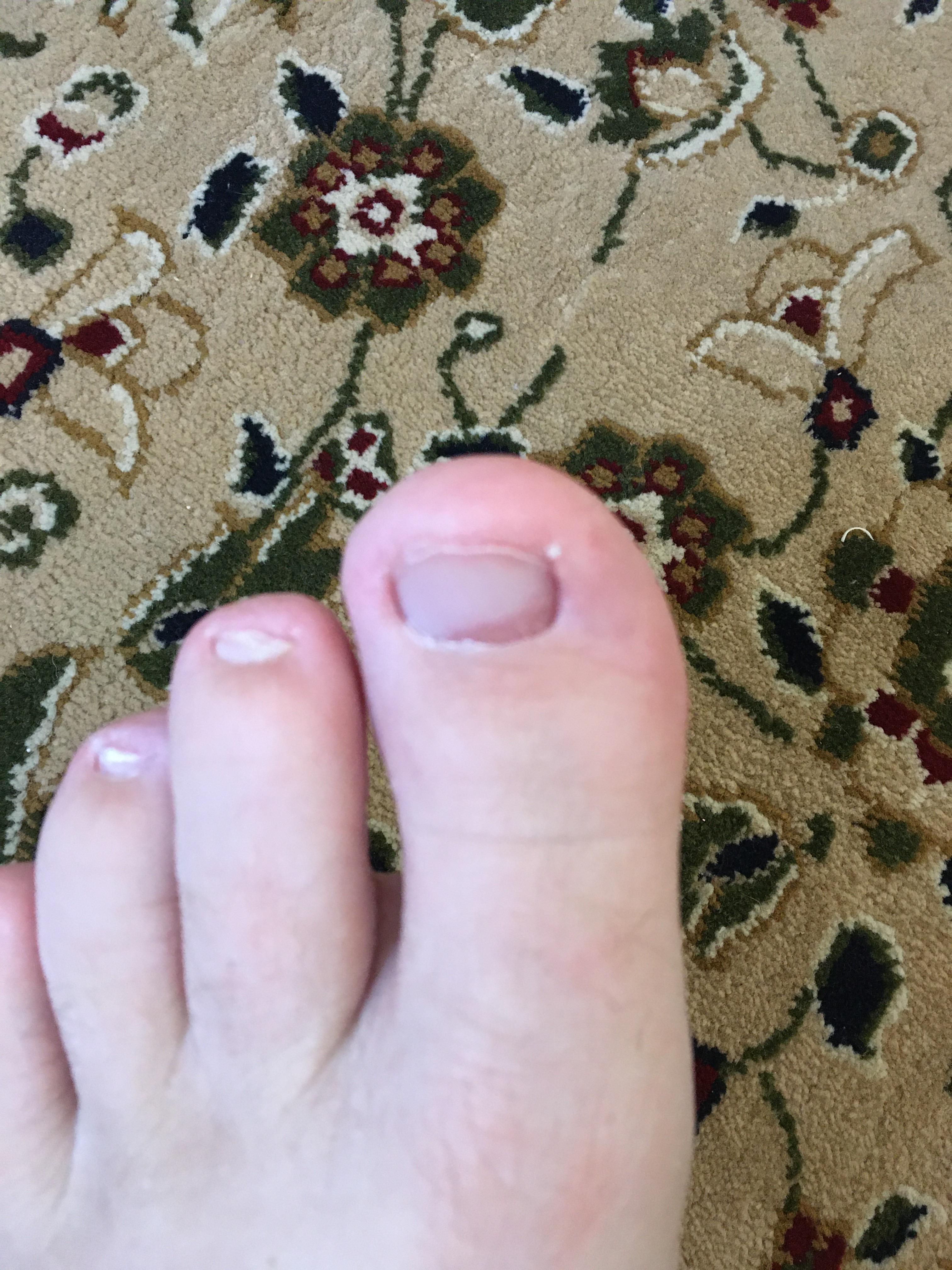 Sudden discoloration under toenail and pain in joint. Any ideas as to