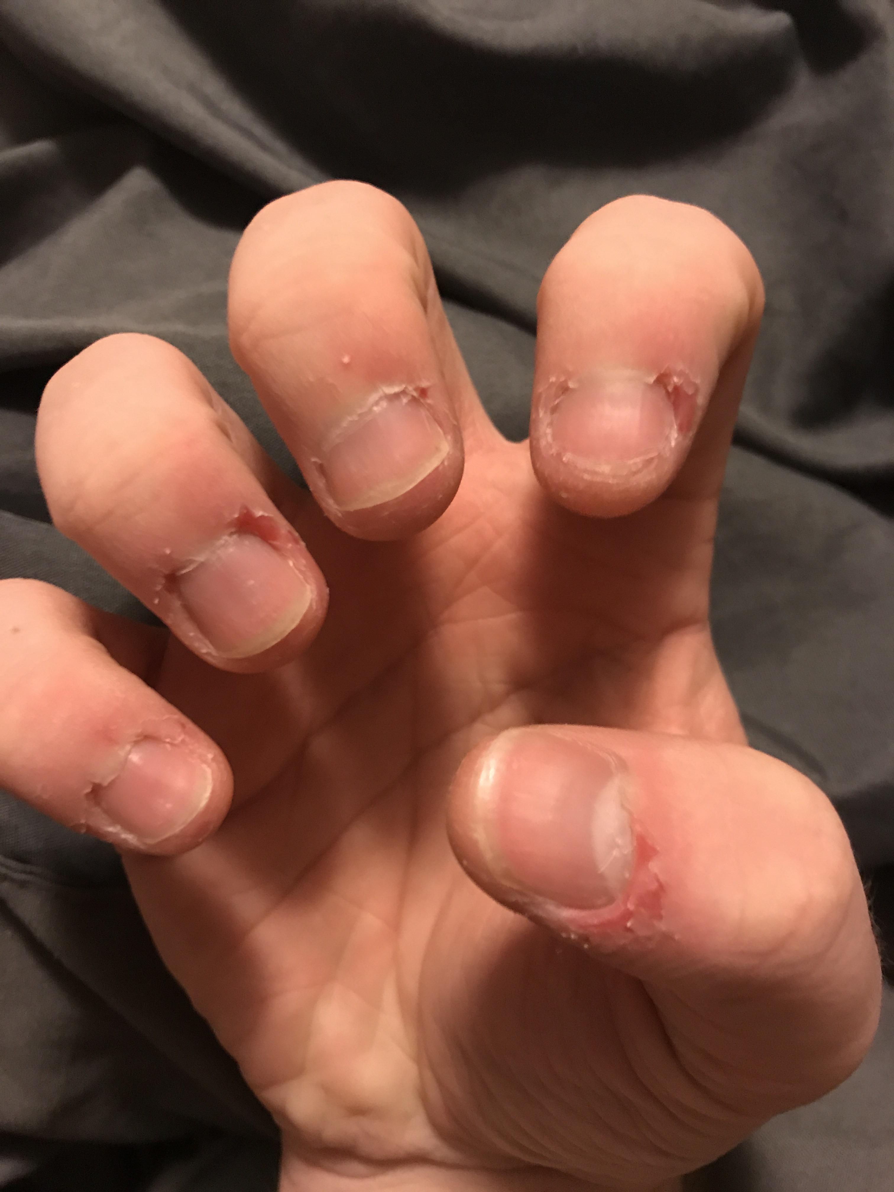 I have a problem with biting the skin around my nails. Ive been told it might be anxiety but I