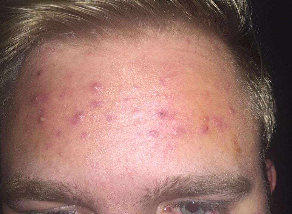 [Skin Concerns] had a very large breakout of cystic acne on my forehead