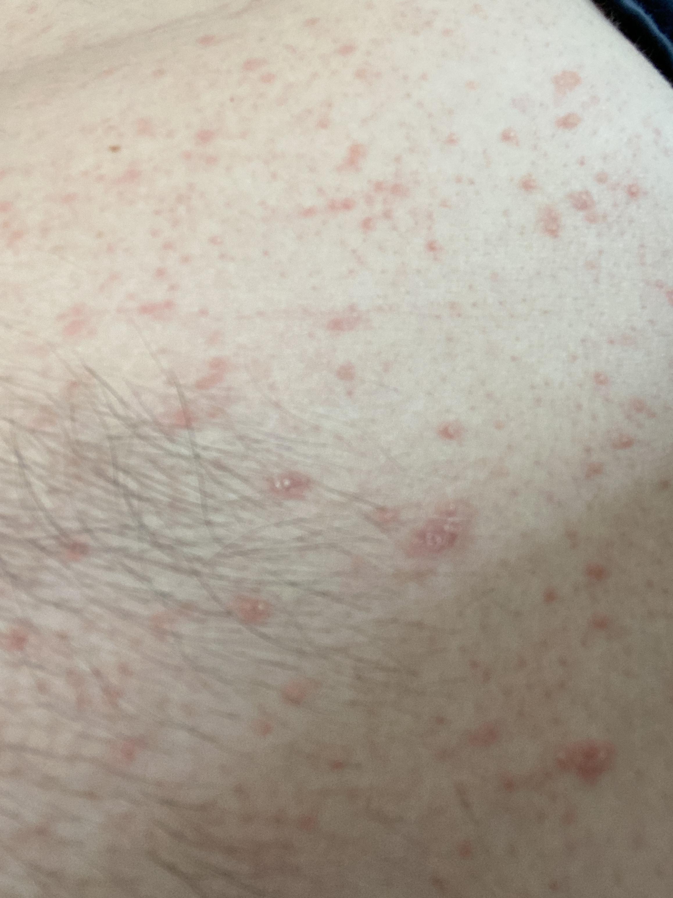 Help identifying? Rash all over torso and back. Does not itch nor hurt