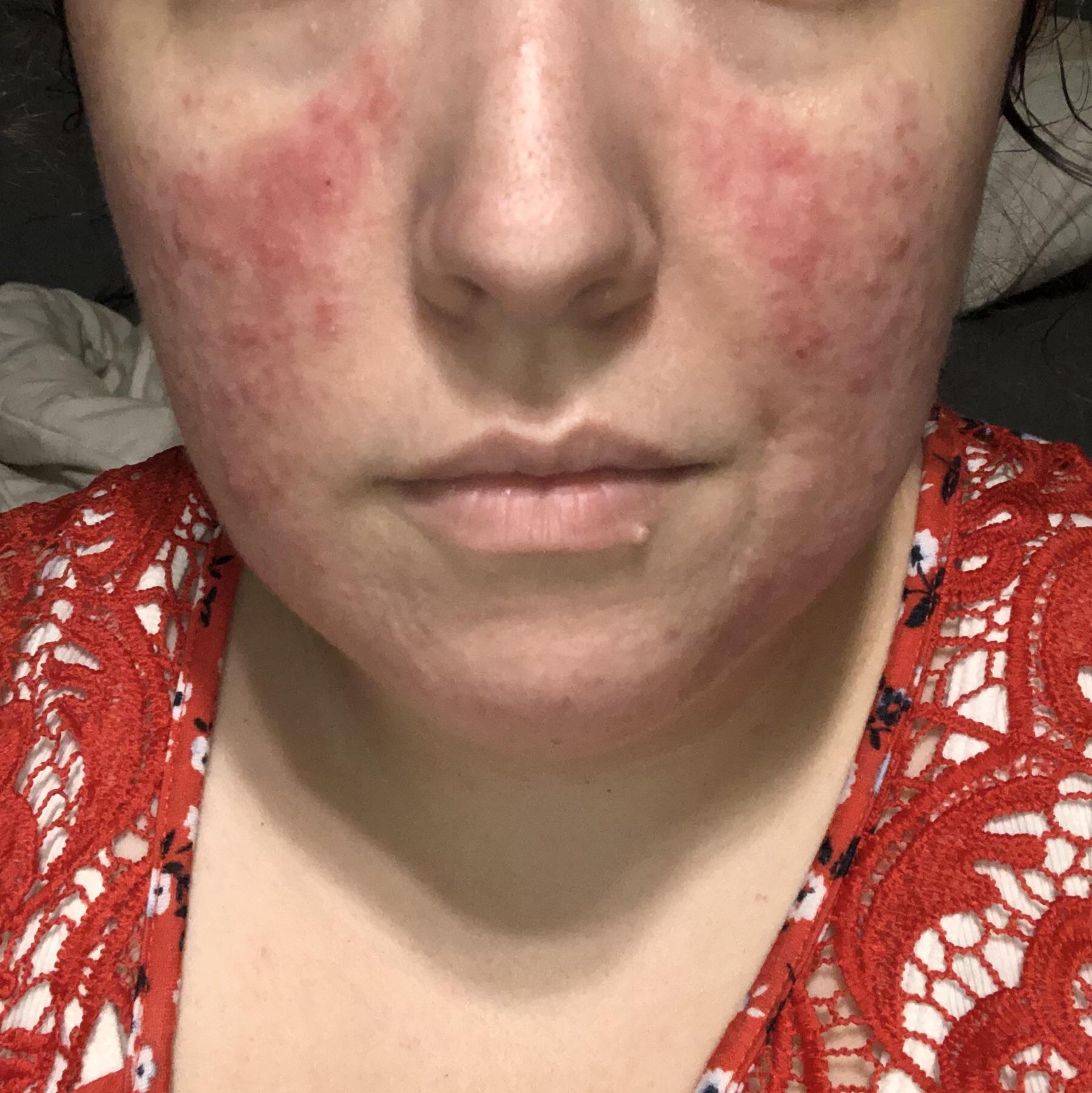 Is this the butterfly rash I’m reading about? r/lupus