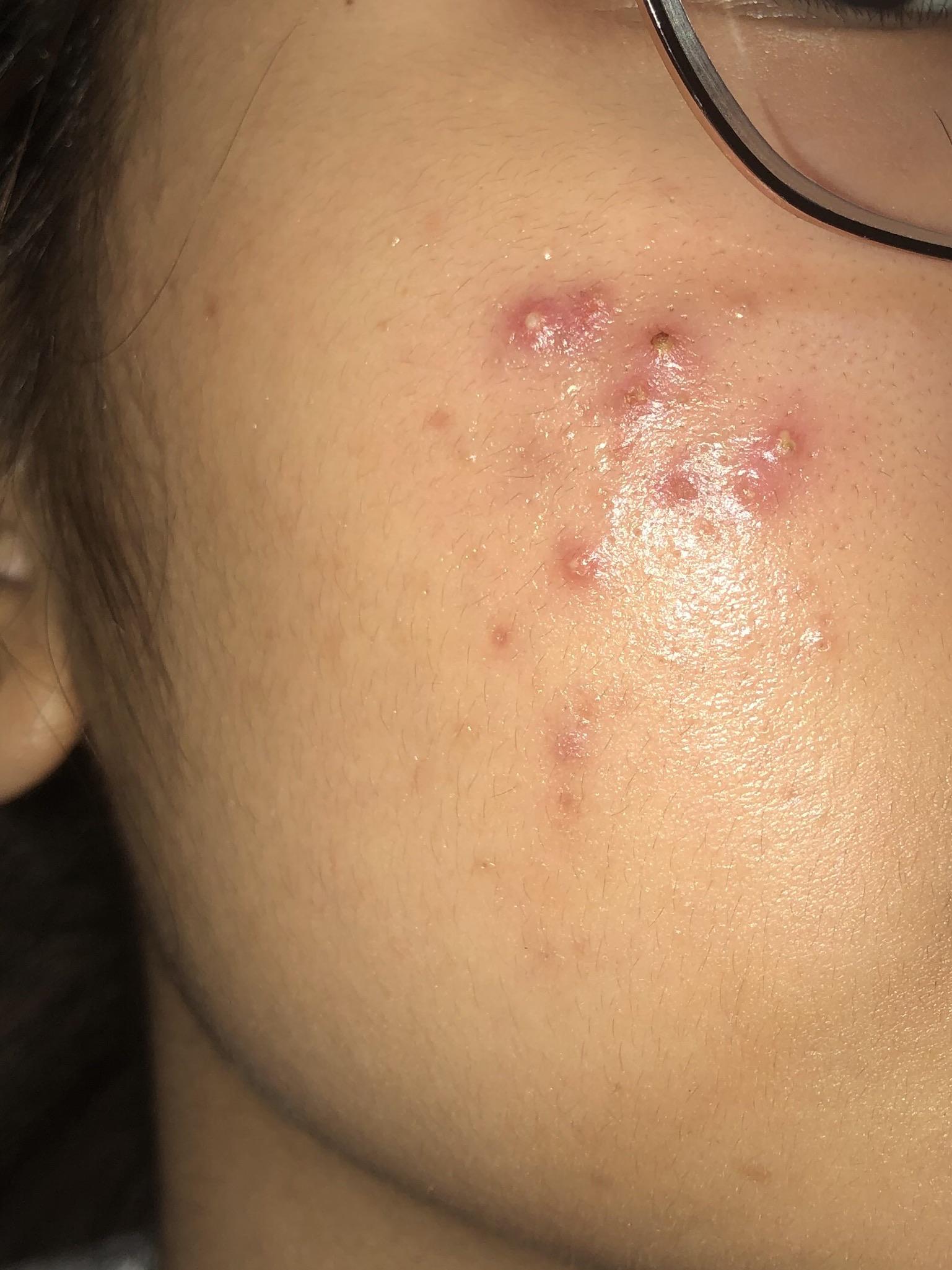 does this look like purging? r/acne