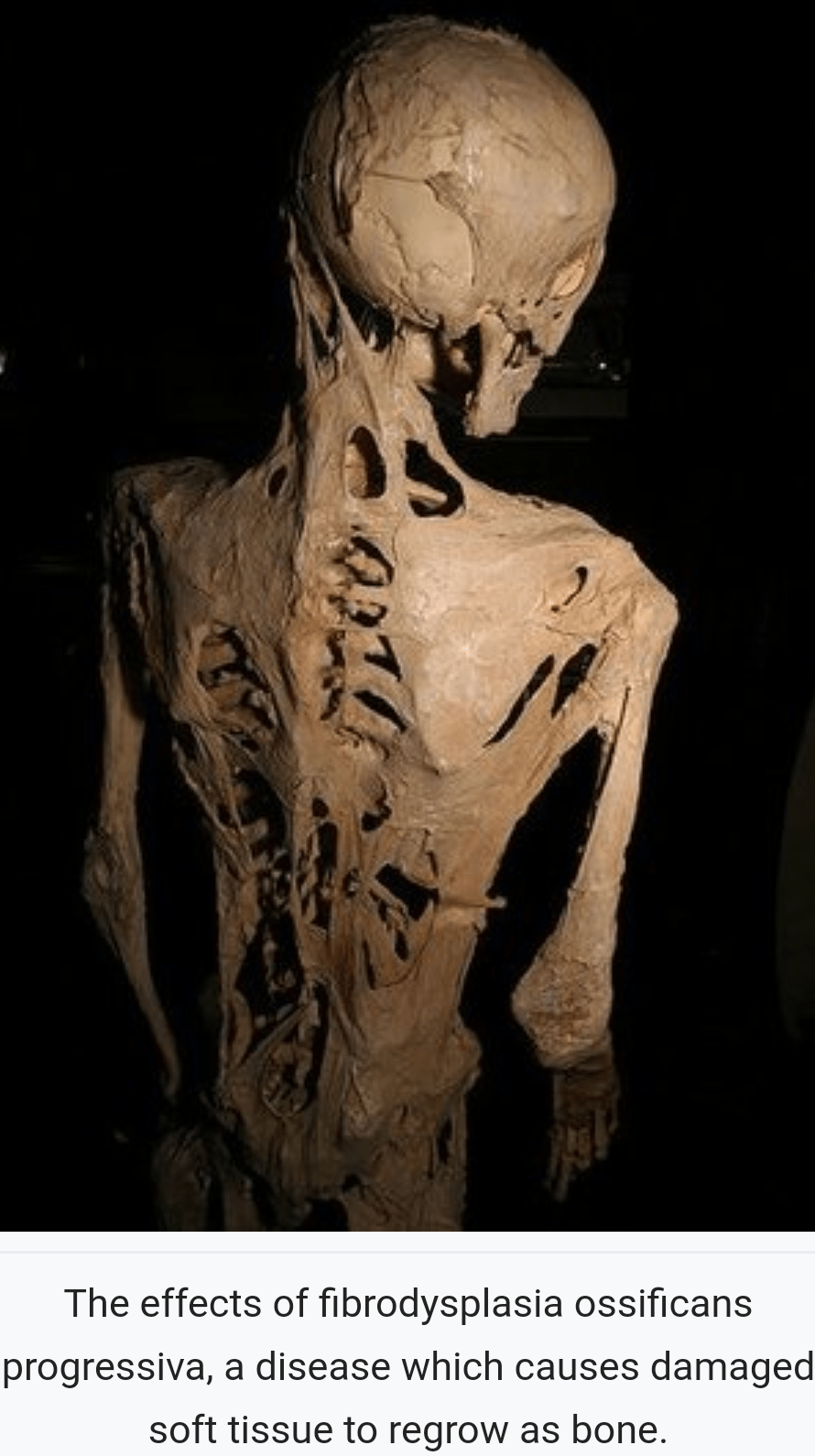 There's a disease called FOP that turn tissue into bone. Neverbrokeabone