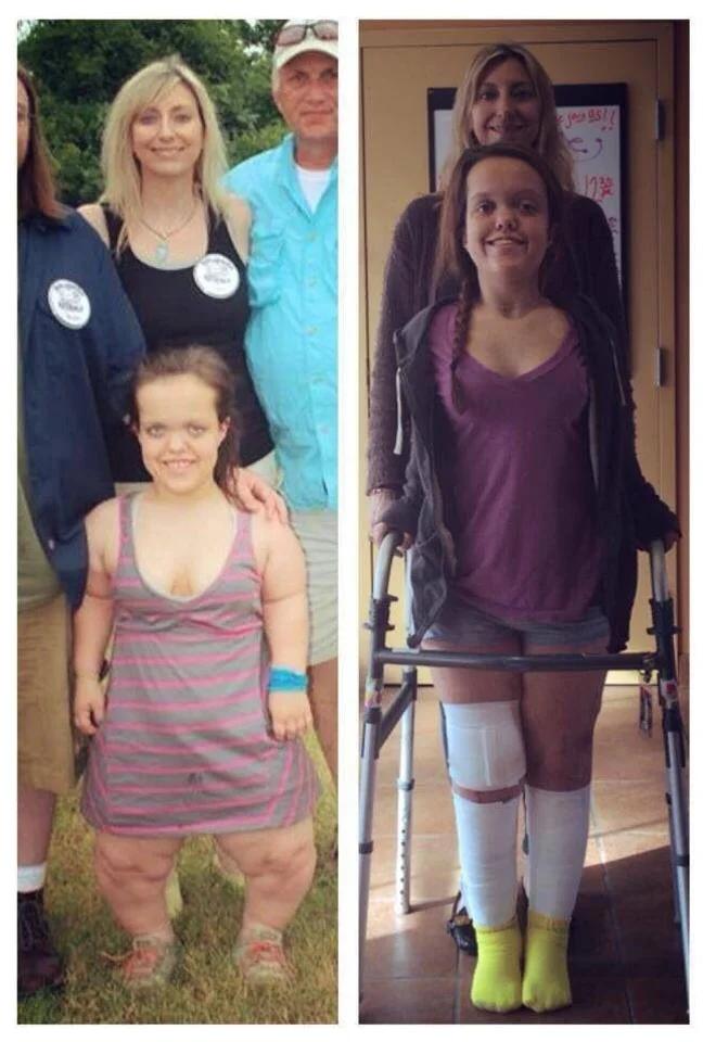 Before and after leg lengthening. via /r/interestingasfuck daslikes