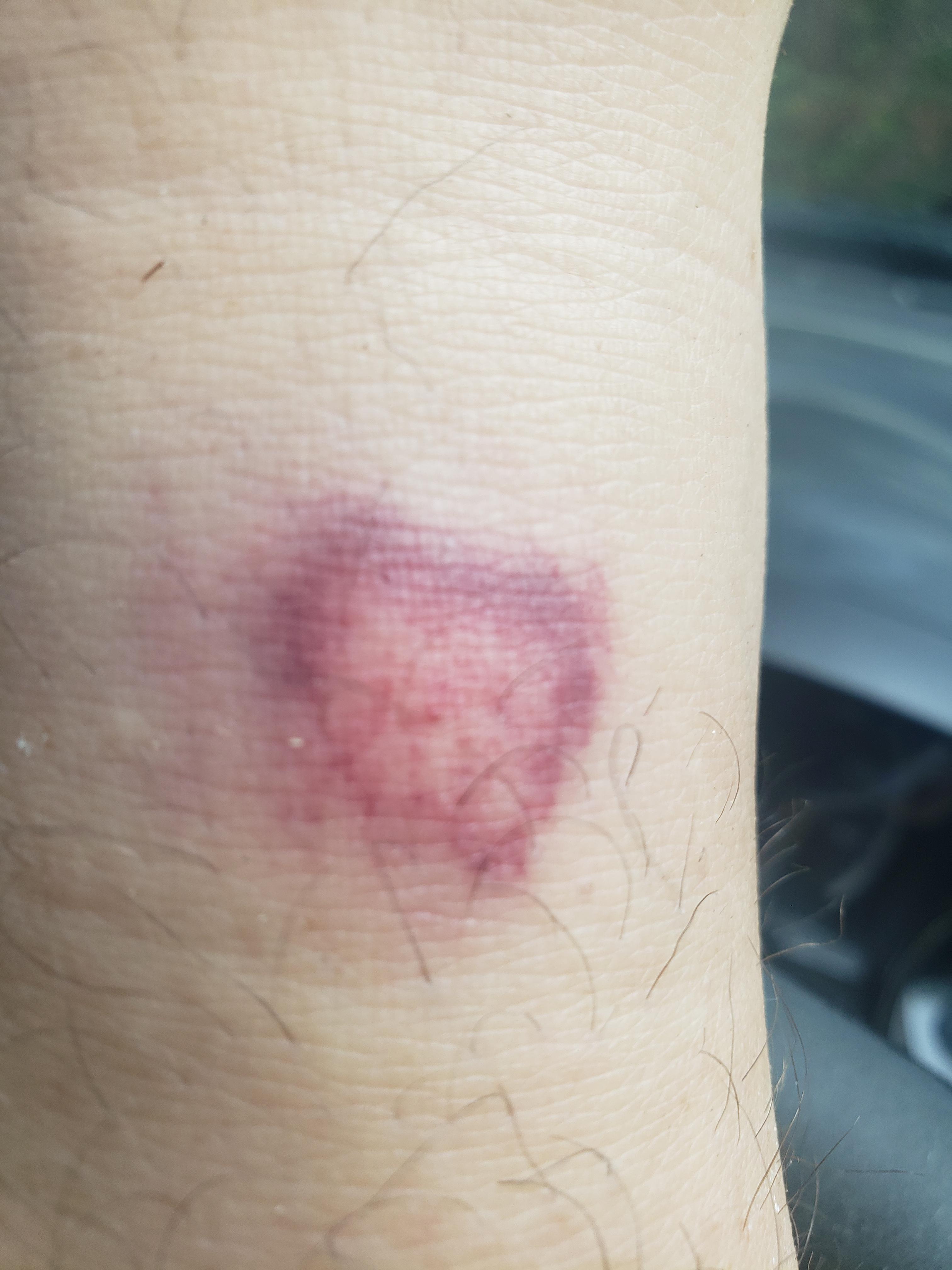 Got bit by something today. Just over my sock line. In South county RI