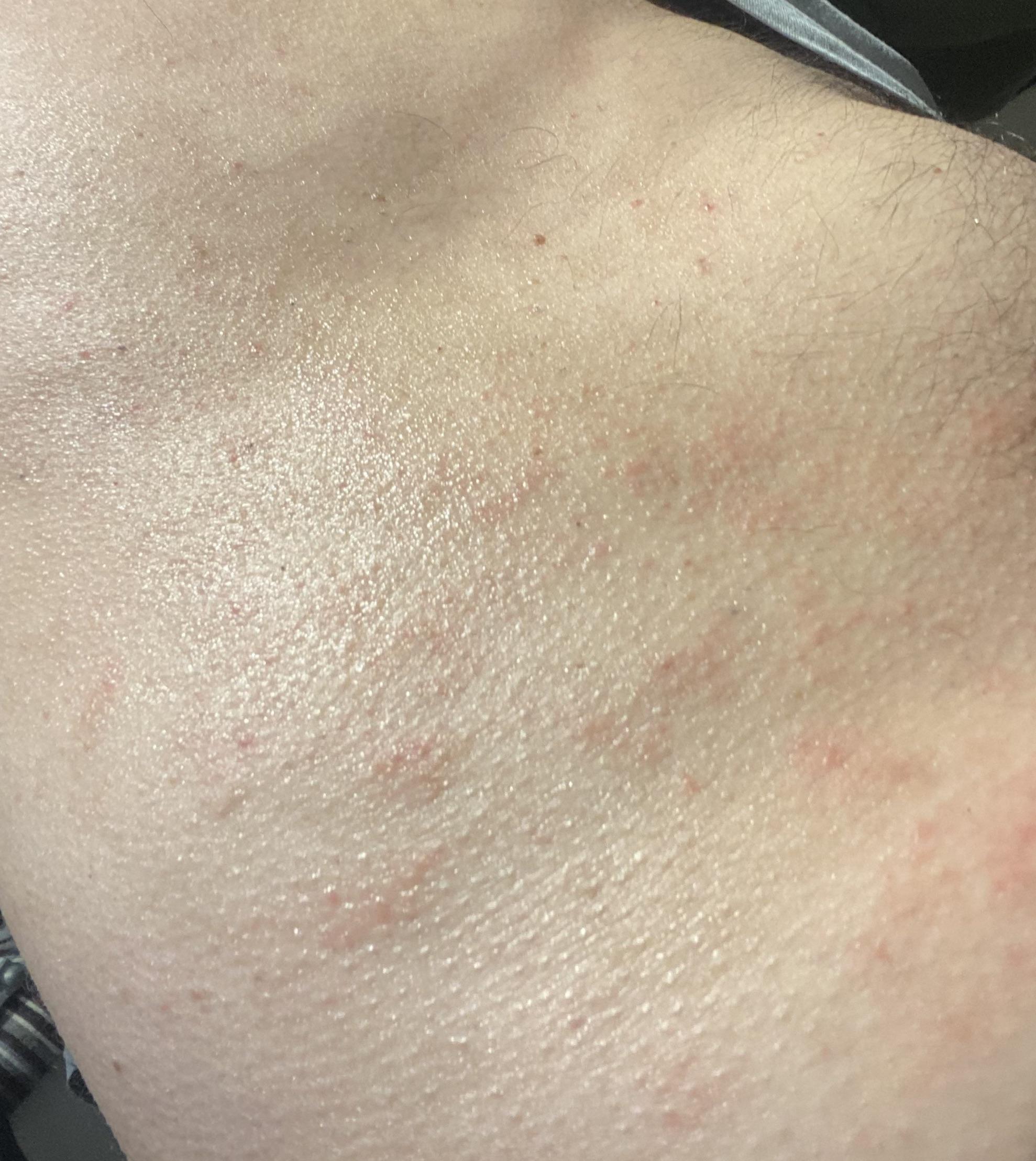 Eczema on torso is moisturiser making it worse??? r/EczemaUK