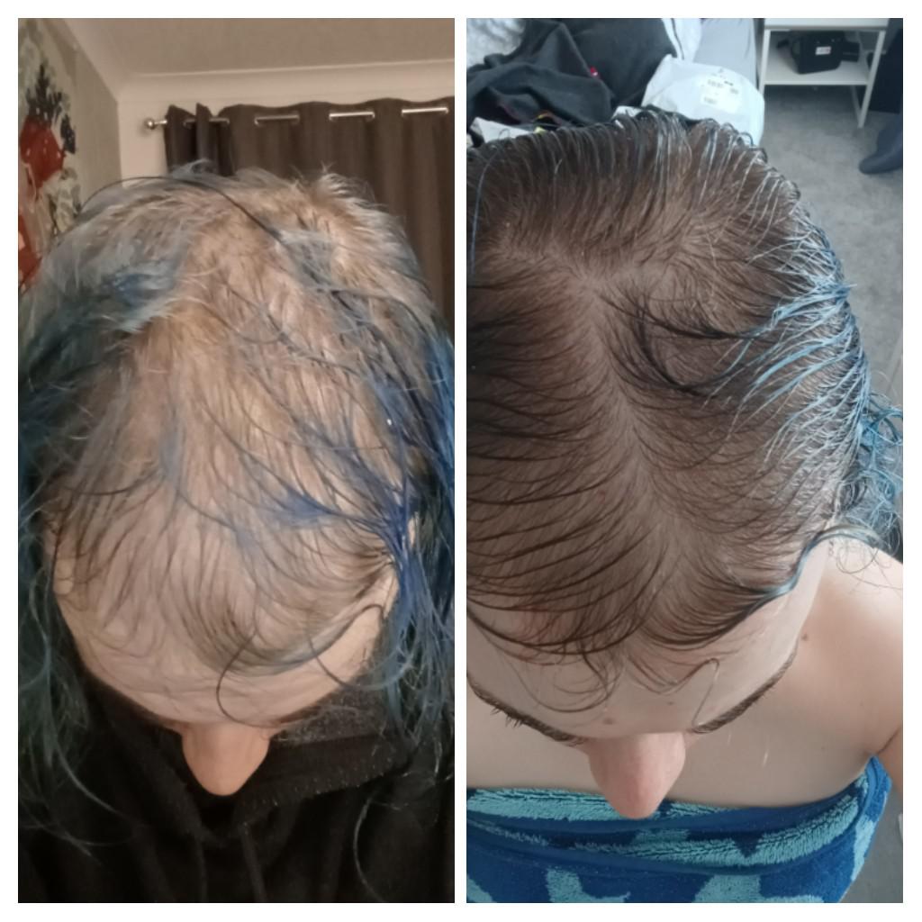 Does Vitamin B12 Help Regrow Hair at Boyd McCray blog