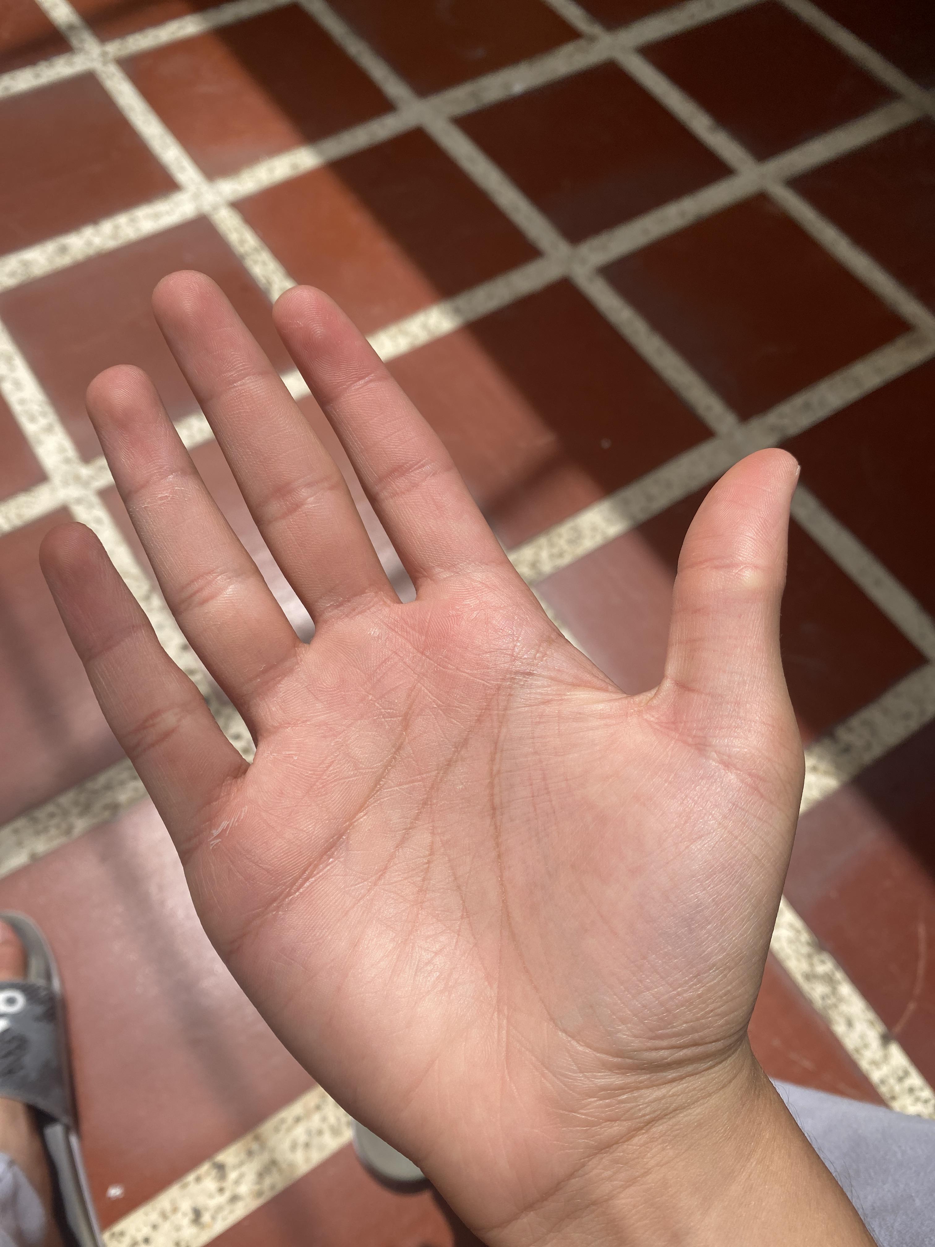 Why are my hands like this r/medical