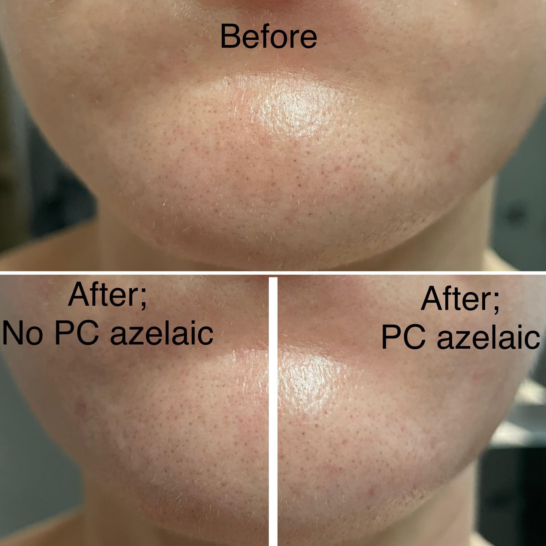 [B&A] 41F Two months of PC Azelaic acid booster on one side of chin only (no change) r