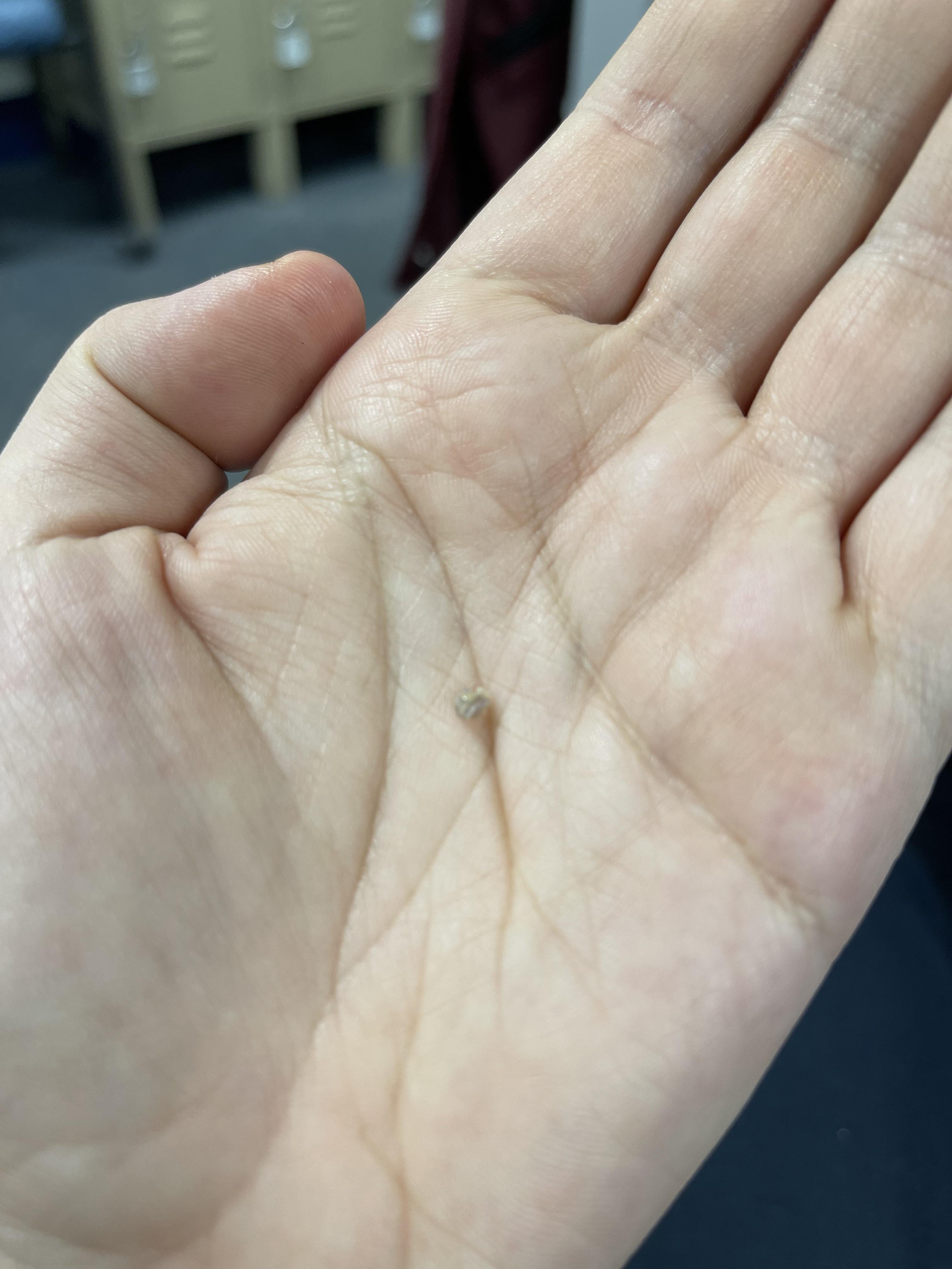 4 week post extraction/bone graft, pieces still falling out. Did my bone graft fail? r/askdentists