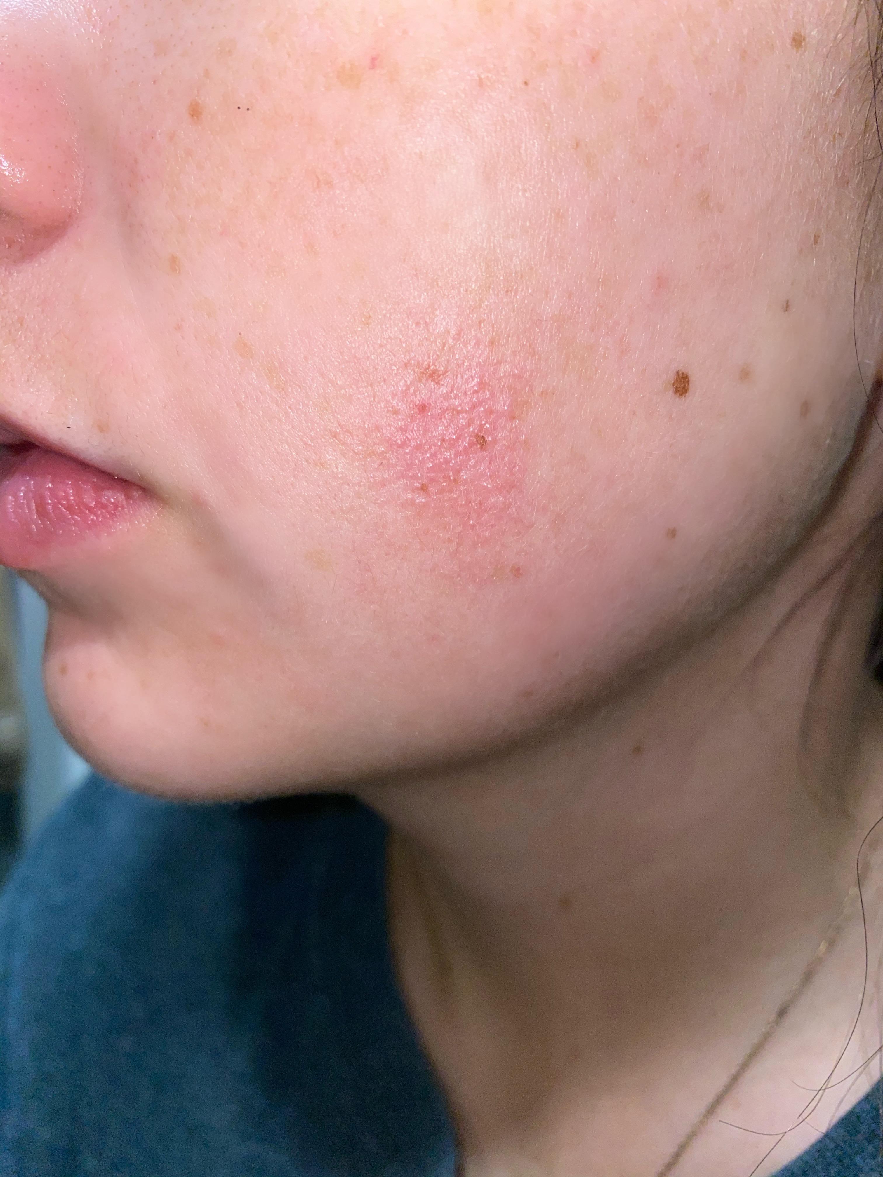 Rash Bumps On Face Pictures Photos vrogue.co