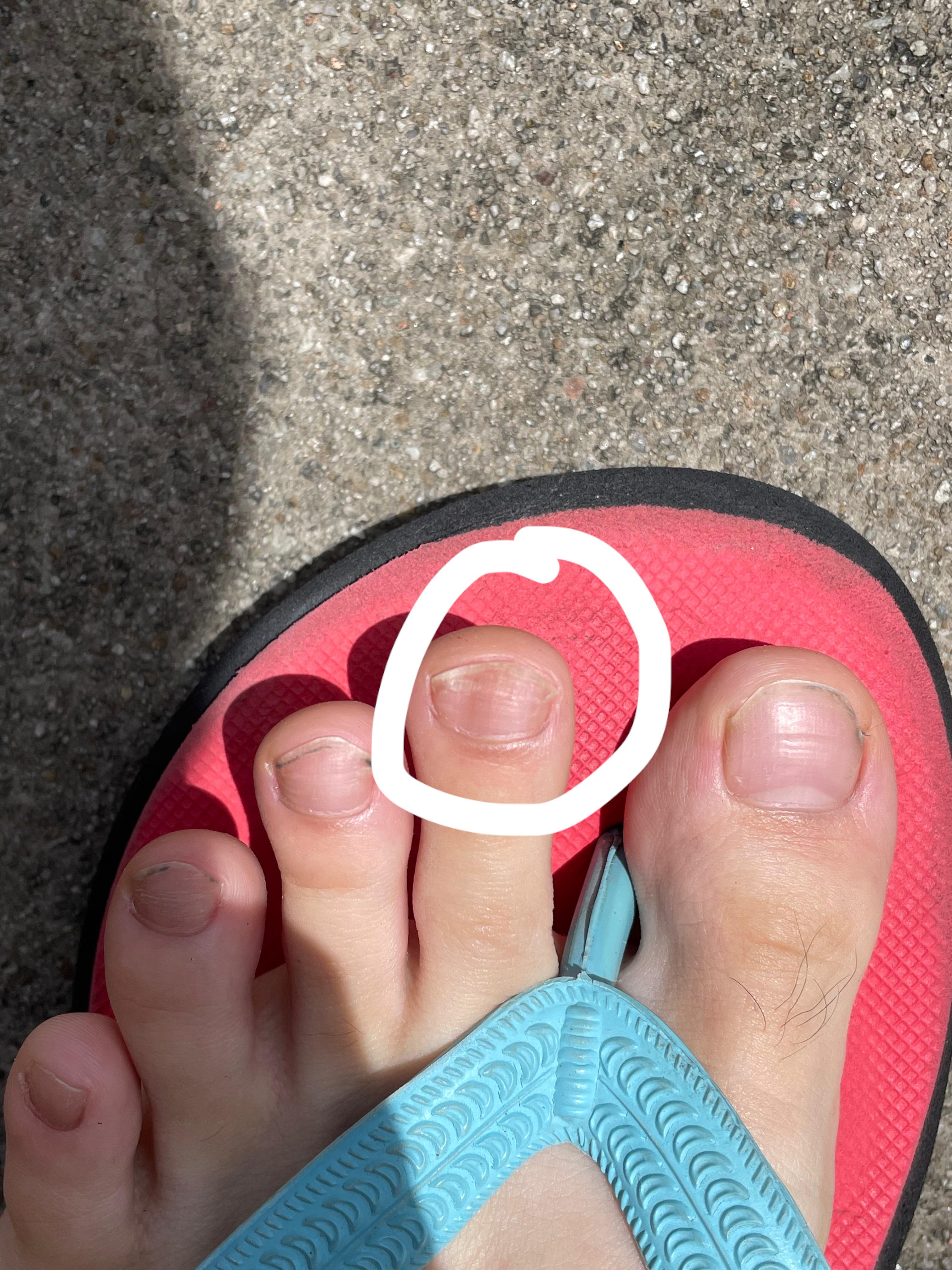 is this blurred borders of the line on my toenail? 14M worried about