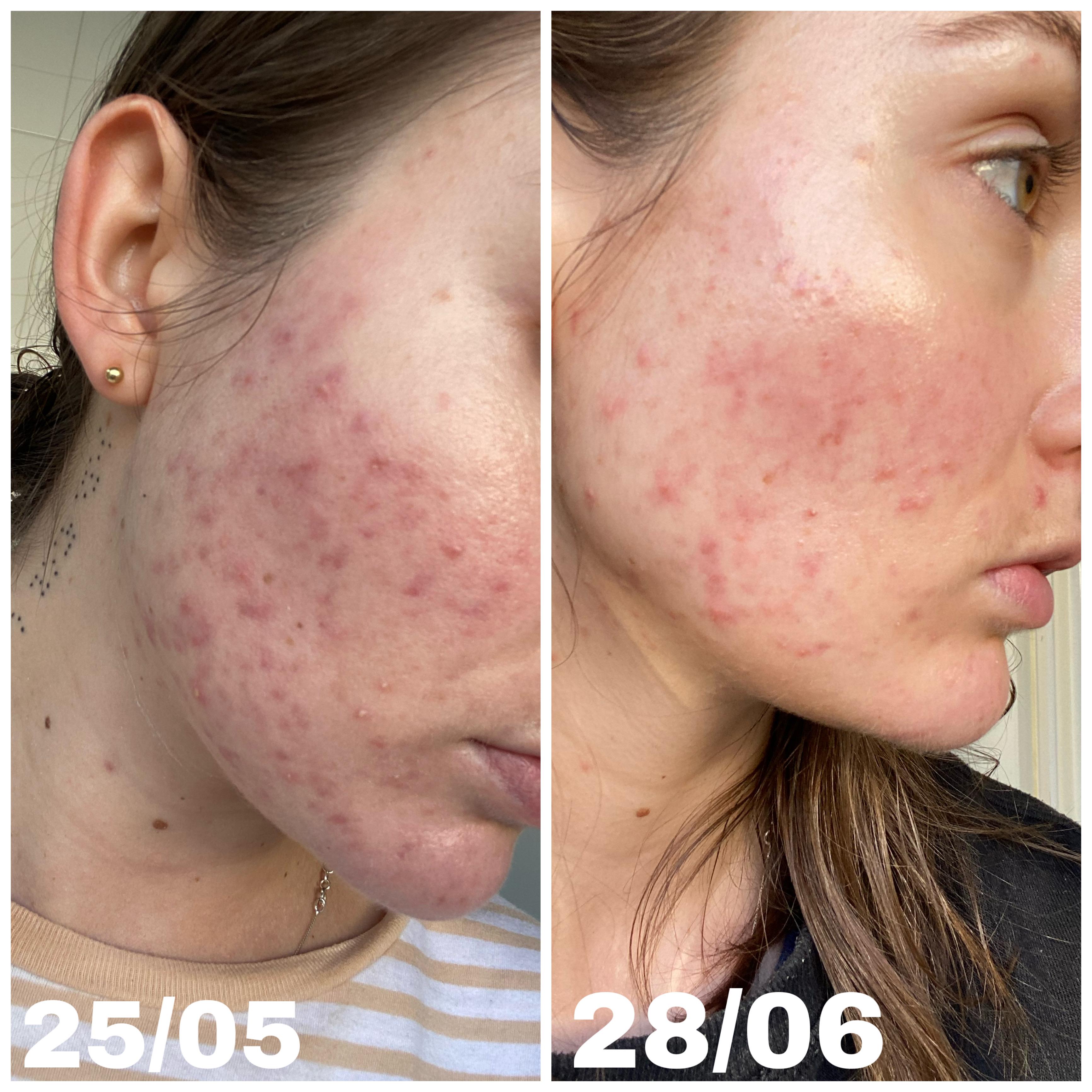 One month using Finacea and cleansing with Hemp oil. r/acne