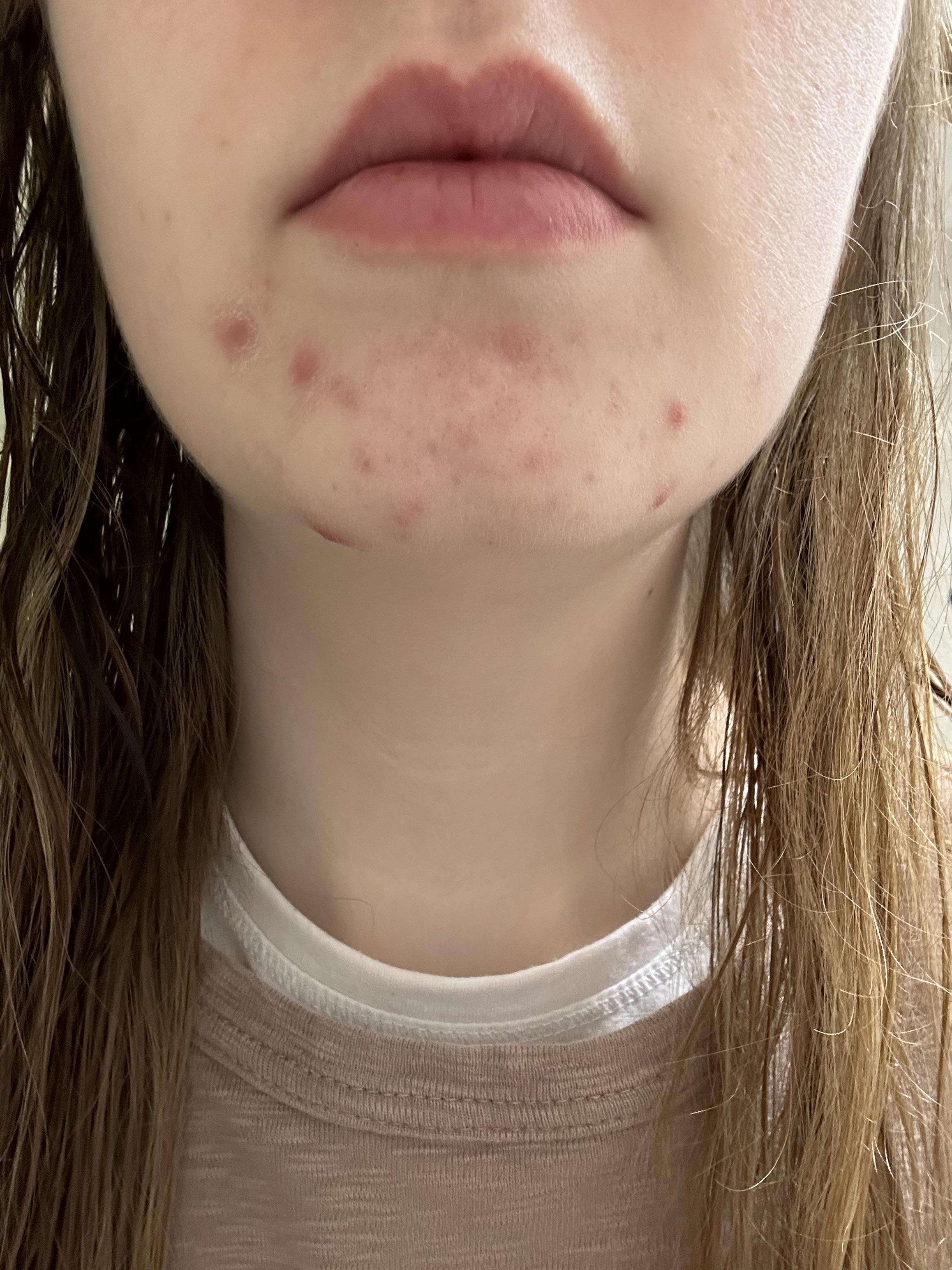 Chin Acne r/acne