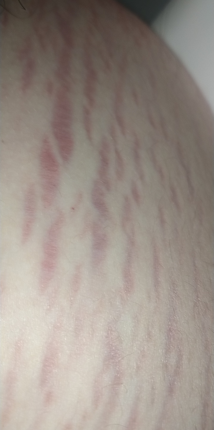 I was wondering what these purple scar type lines are they are on both