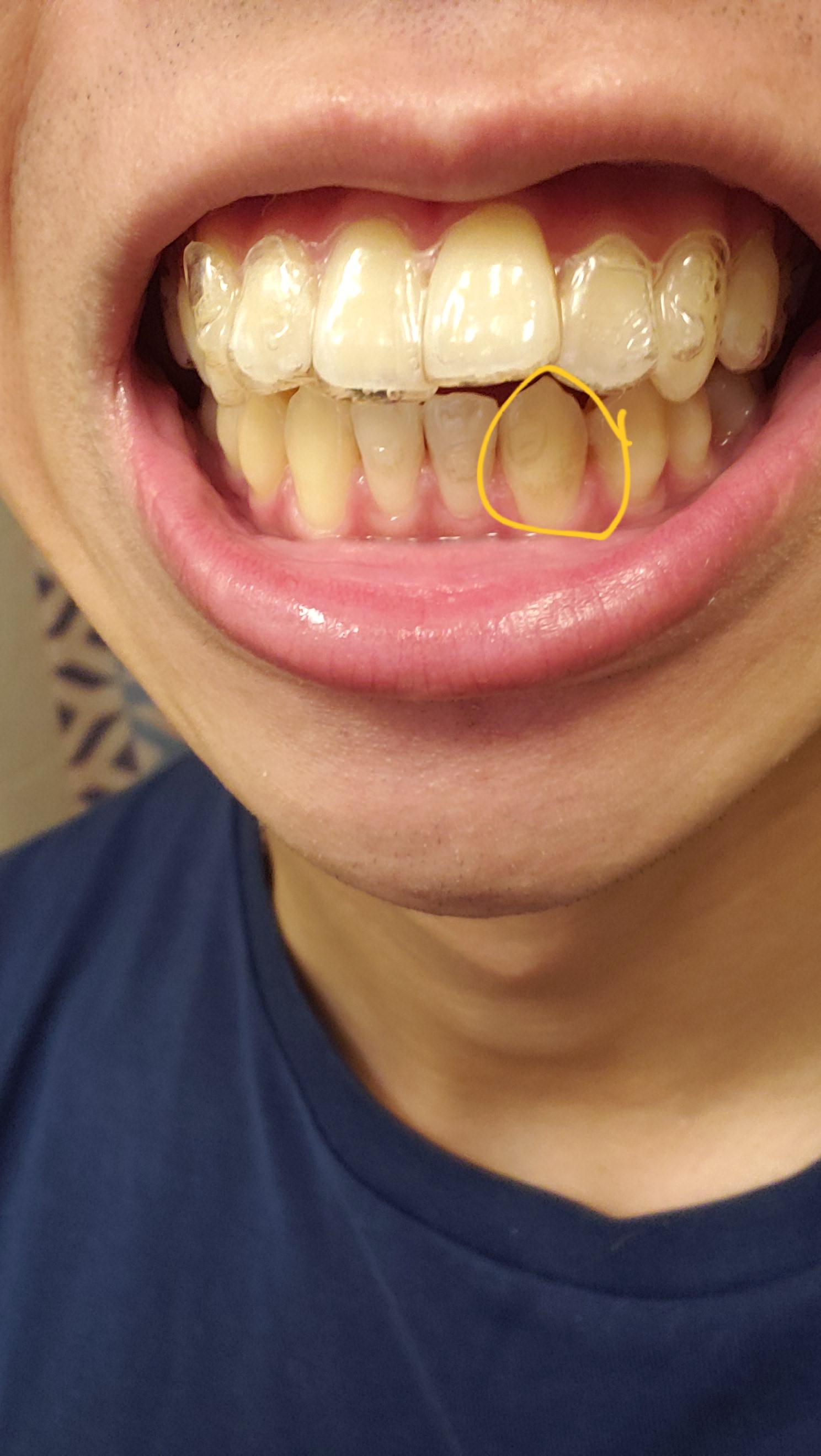 So while I was brushing teeth after eating i found out this. Is this