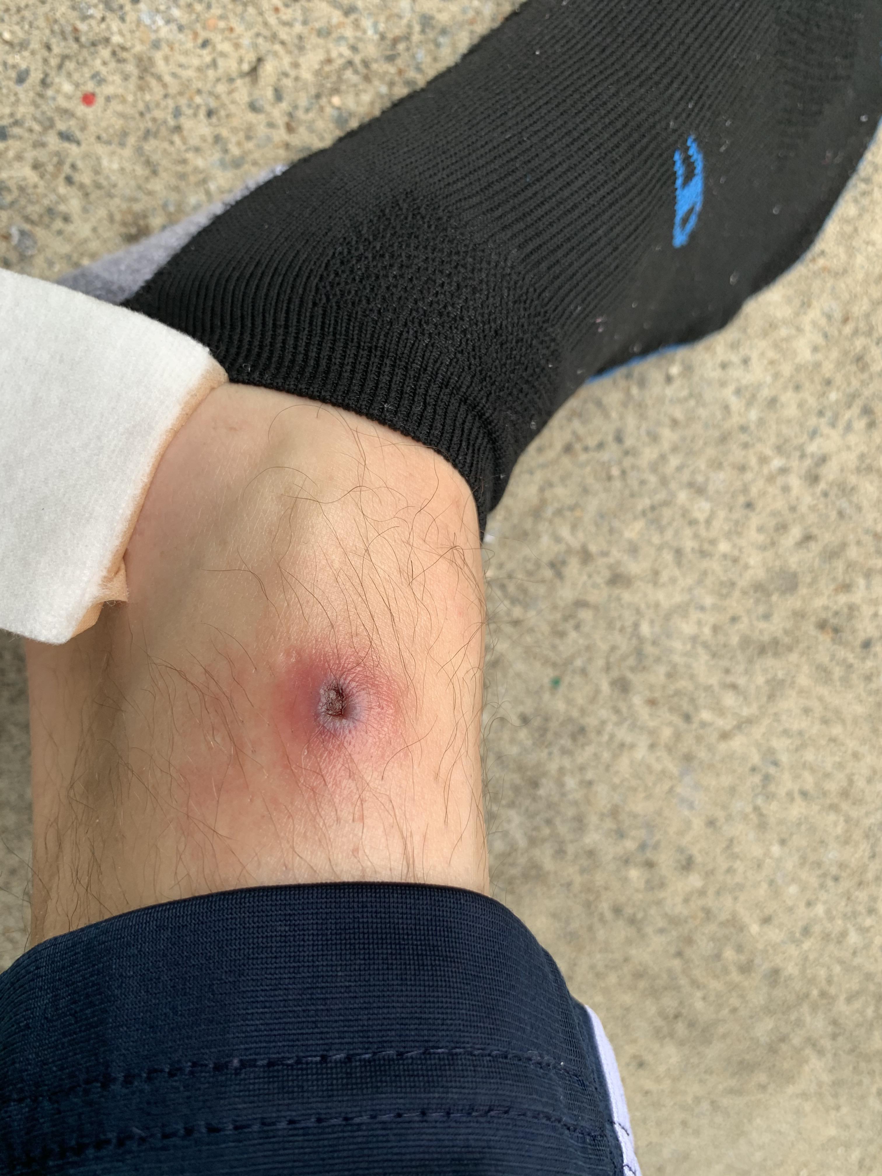 Anyone know if this bite is poisonous or not? spiderbites