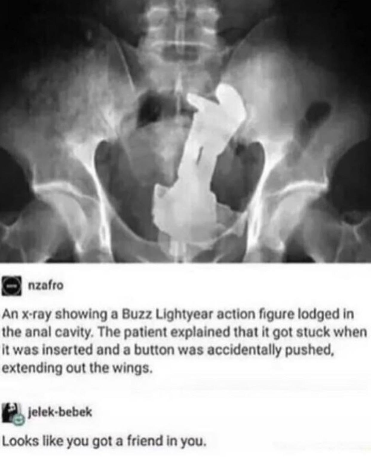 WCGW if I stick a Buzz Lightyear up my butt. r/Whatcouldgowrong